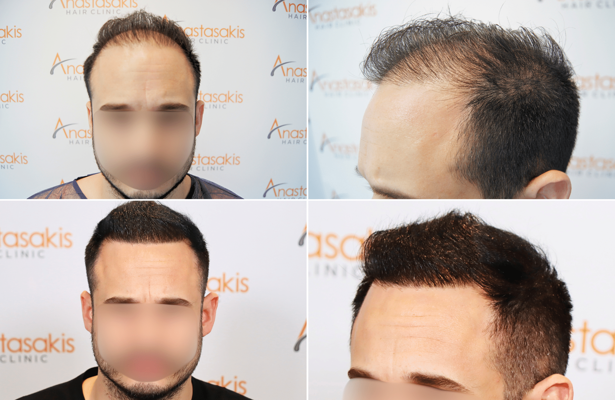https://www.anastasakishairclinic.gr/portfolio/apotelesma-metamosxefsis-mallion-anastasakis-hair-clinic-66/