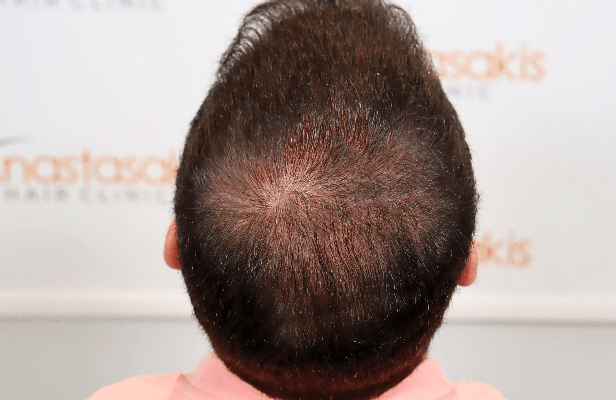 hair transplant result 3500 fus (1)