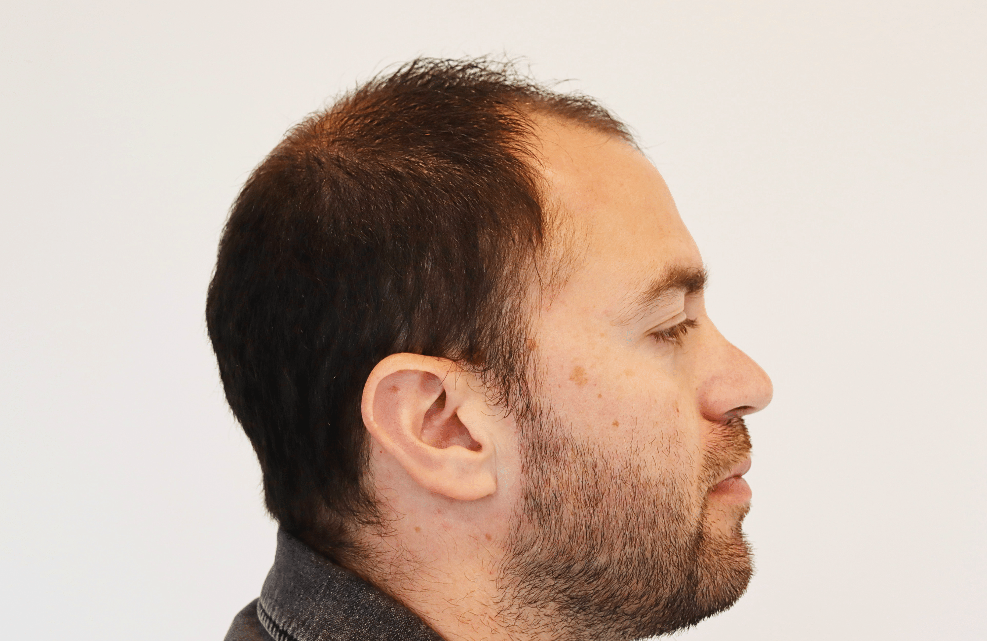hair transplant result 3500 fus (14)