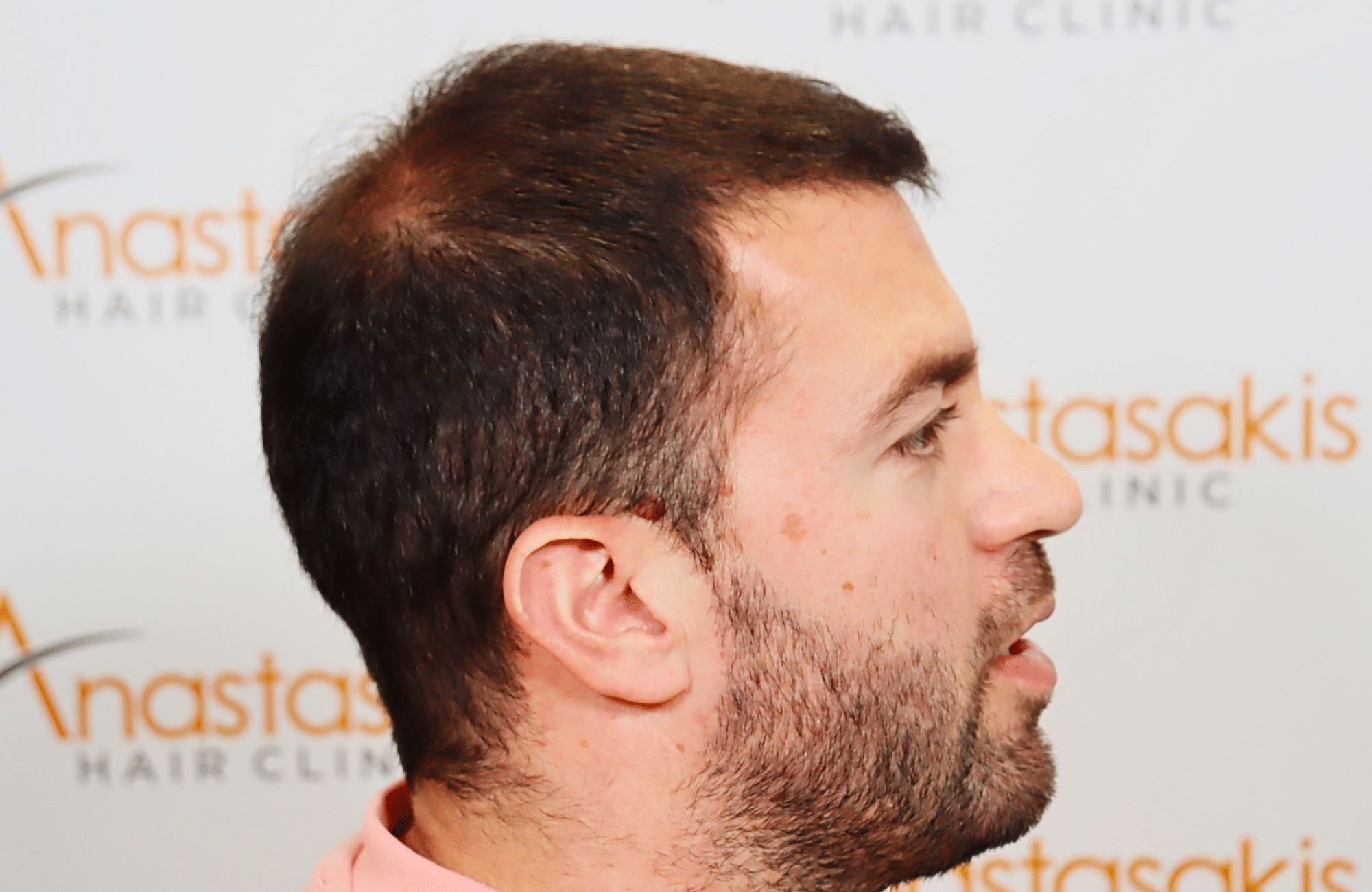 hair transplant result 3500 fus (15)