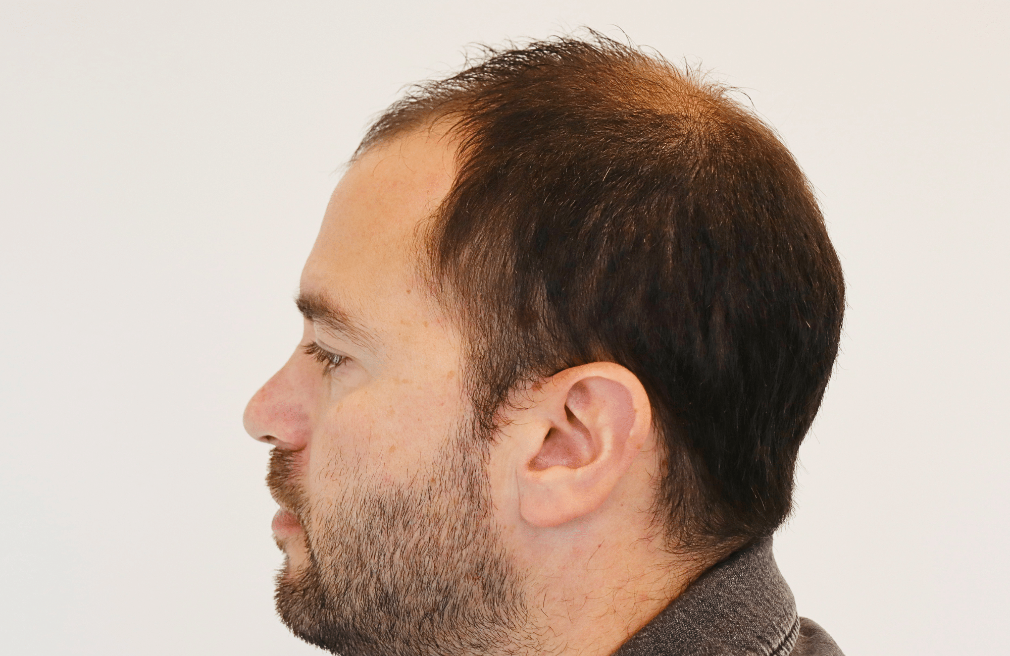 hair transplant result 3500 fus (16)