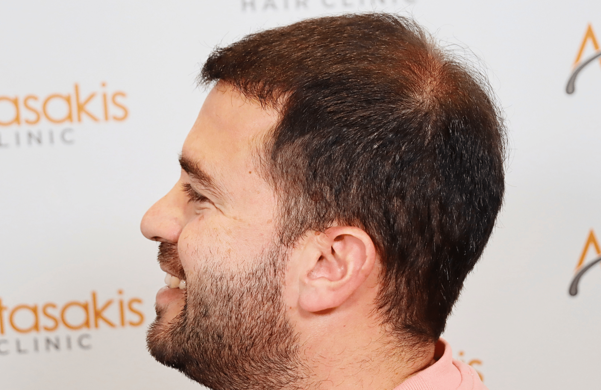 hair transplant result 3500 fus (16)