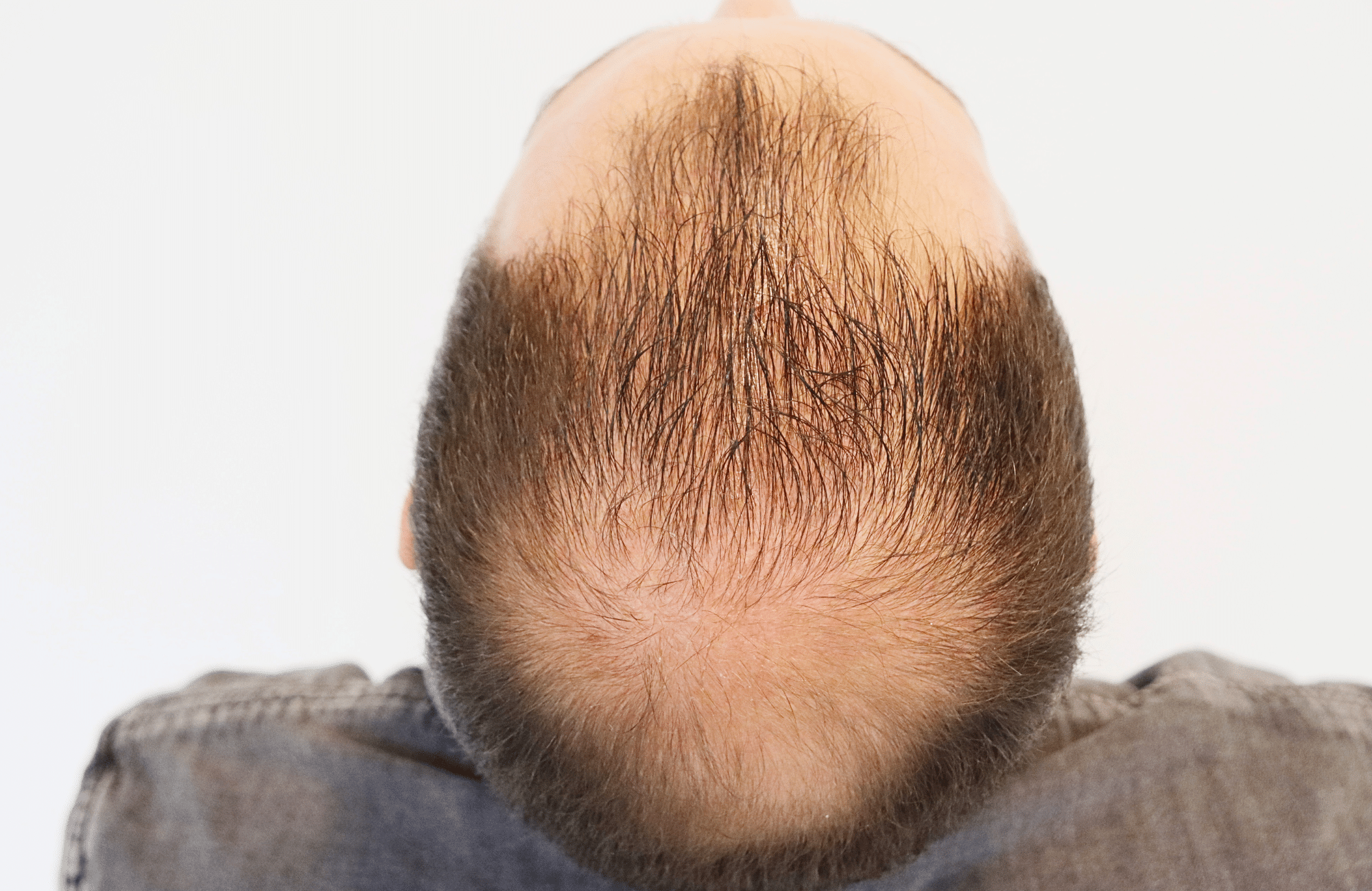 hair transplant result 3500 fus (18)