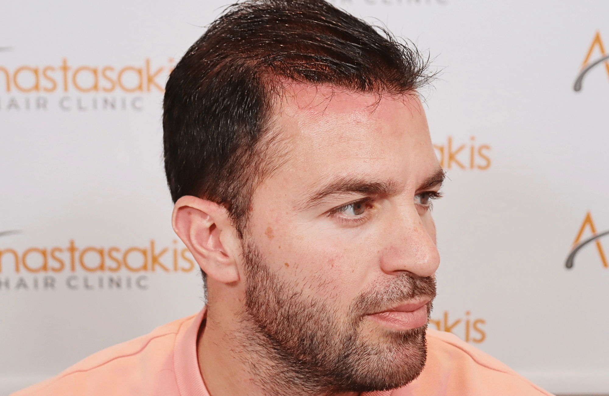 hair transplant result 3500 fus (5)