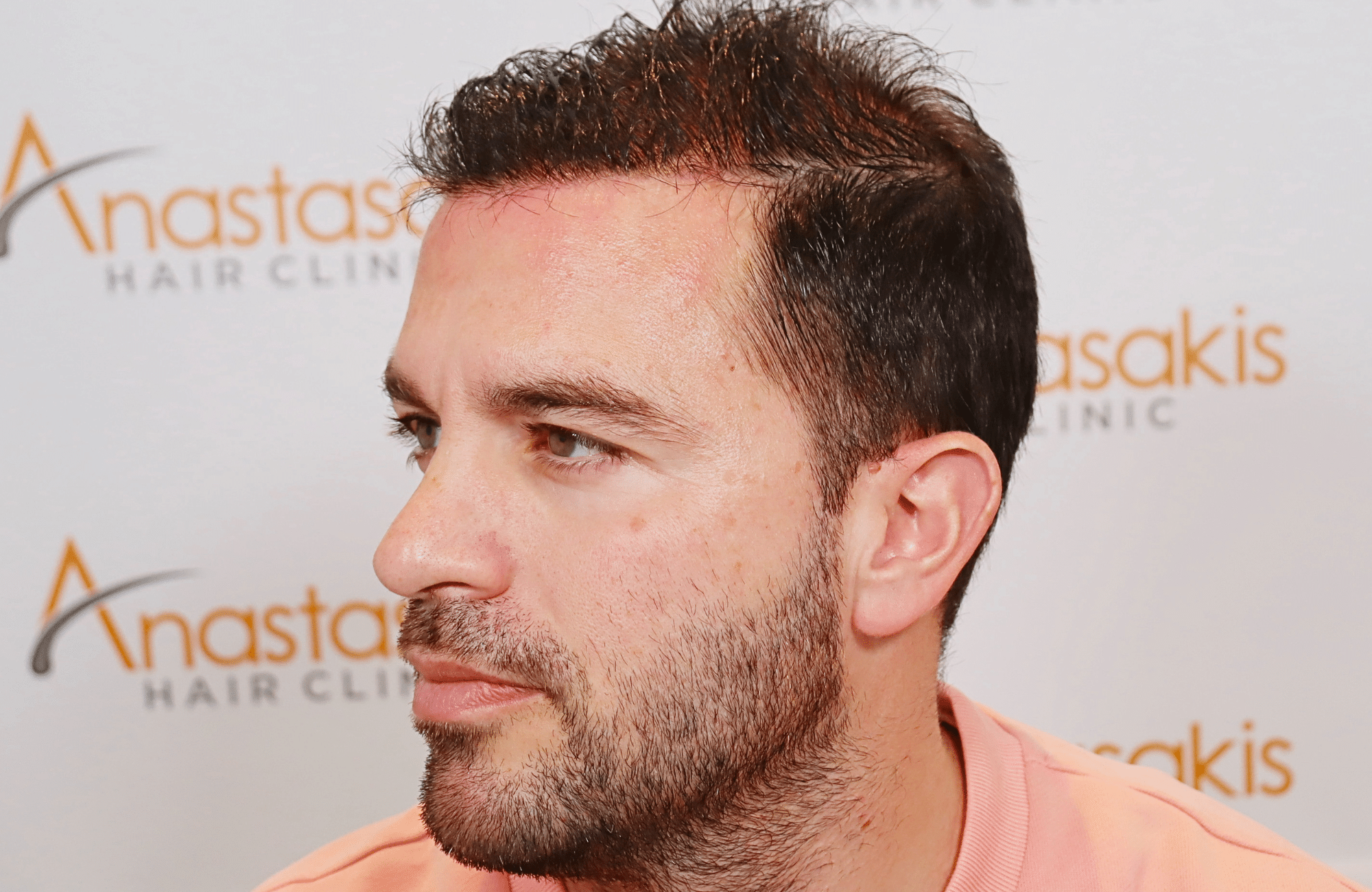 hair transplant result 3500 fus (6)
