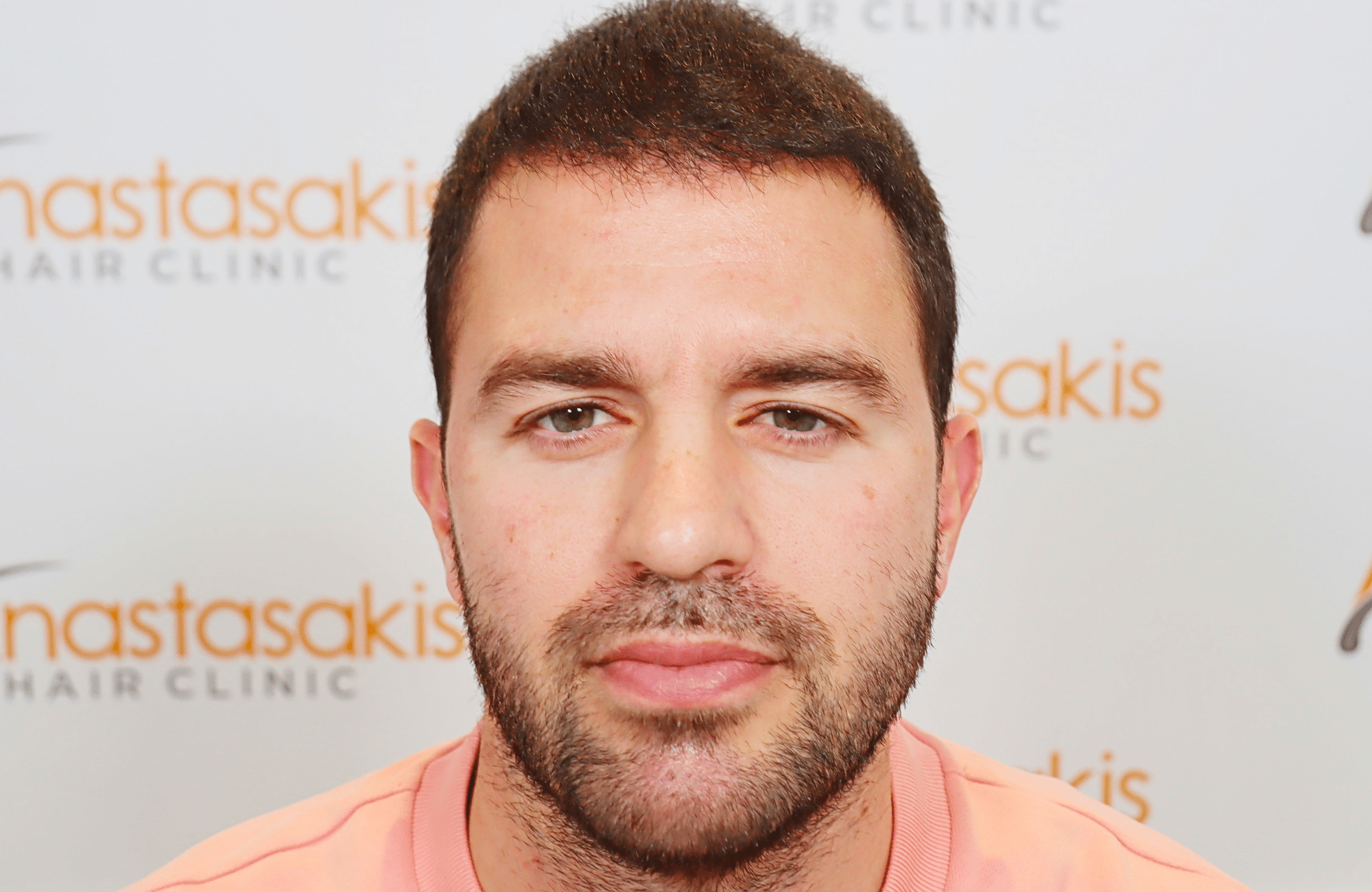 hair transplant result 3500 fus (9)