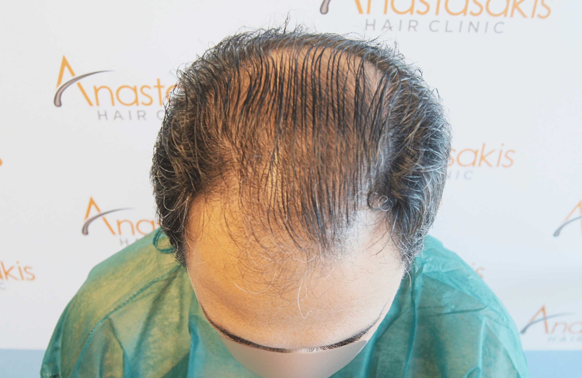 hair transplant result 3500 fus stage 5 (10)