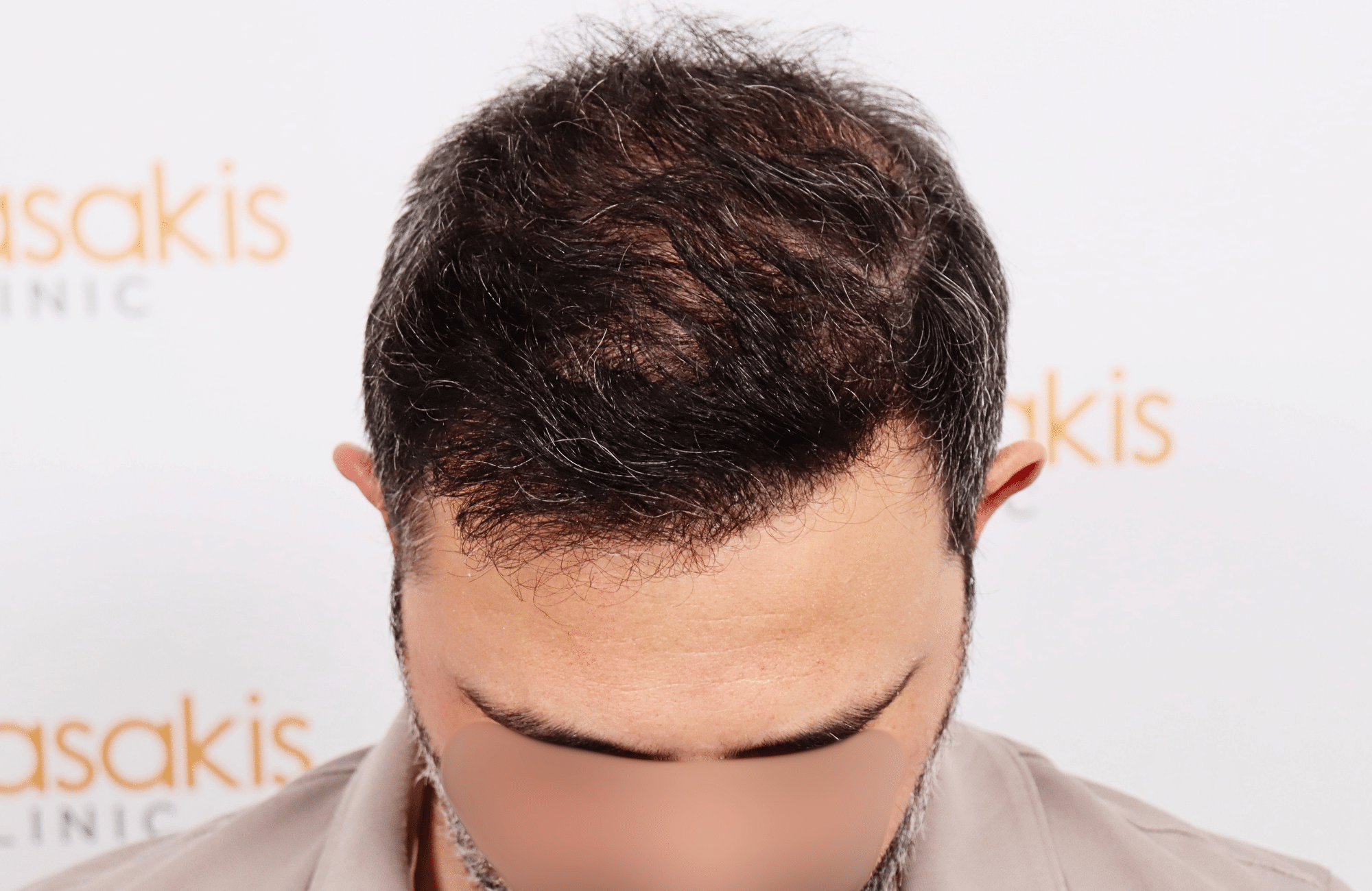 hair transplant result 3500 fus stage 5 (11)