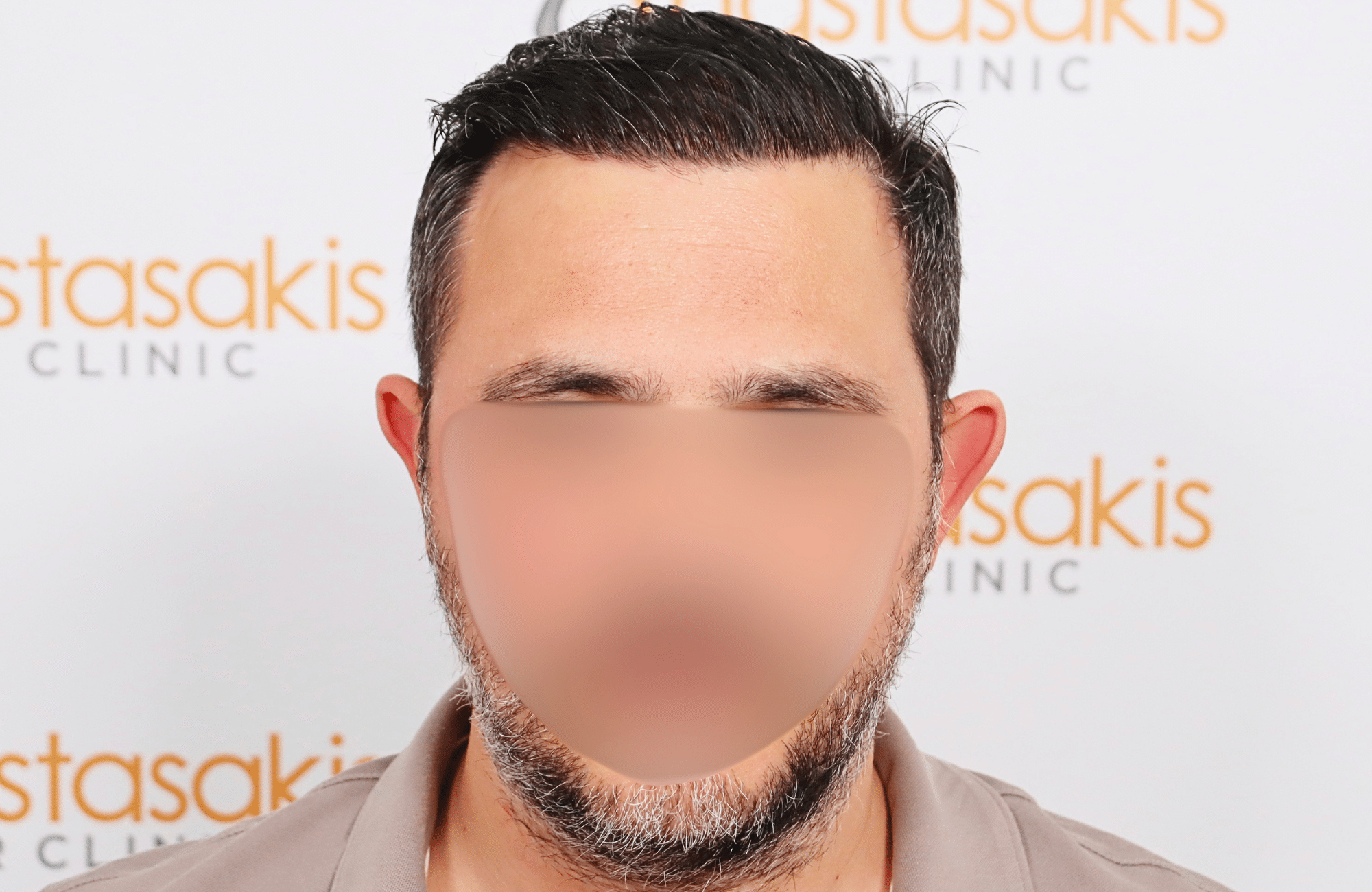 hair transplant result 3500 fus stage 5 (12)