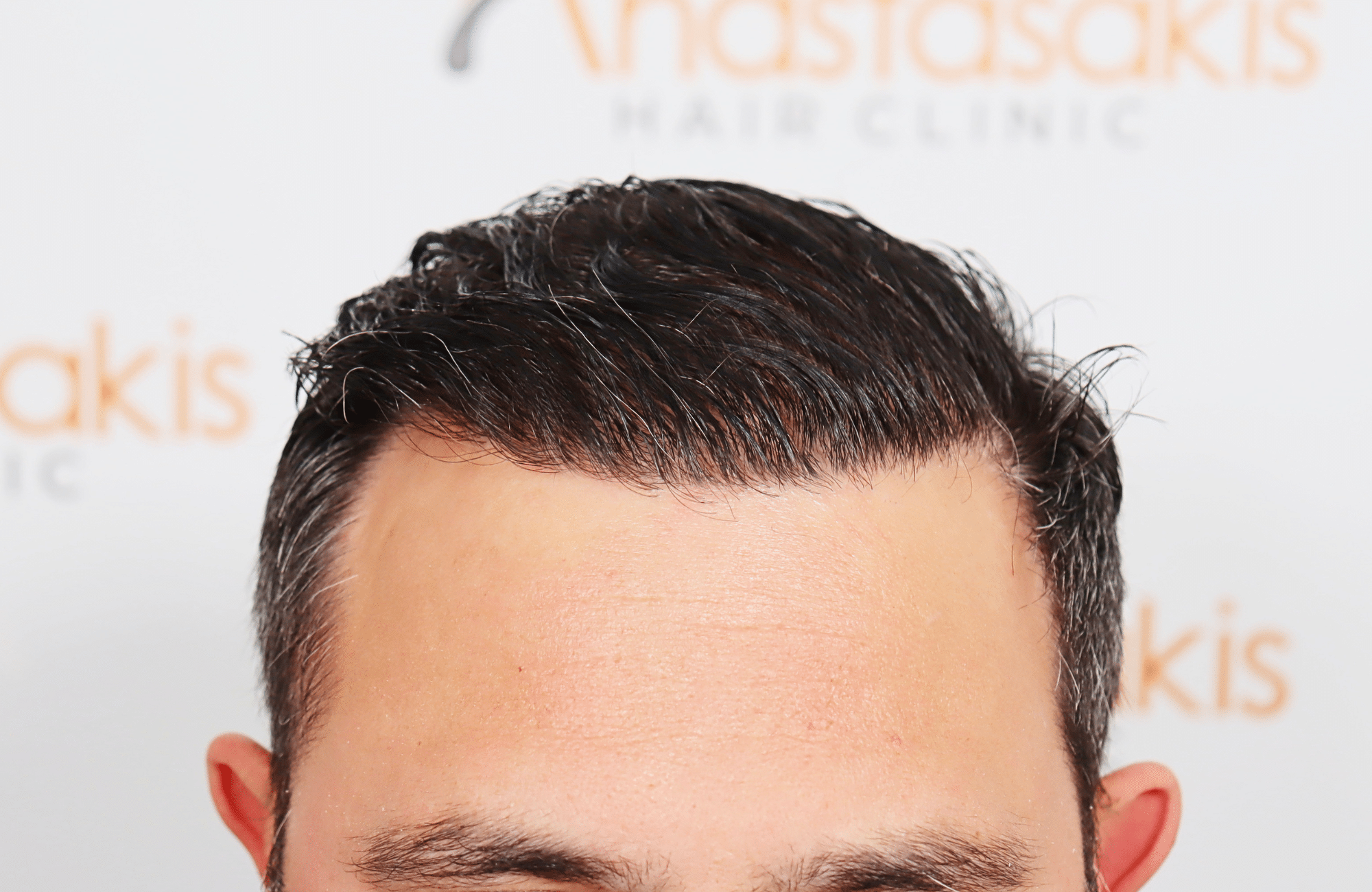 hair transplant result 3500 fus stage 5 (13)