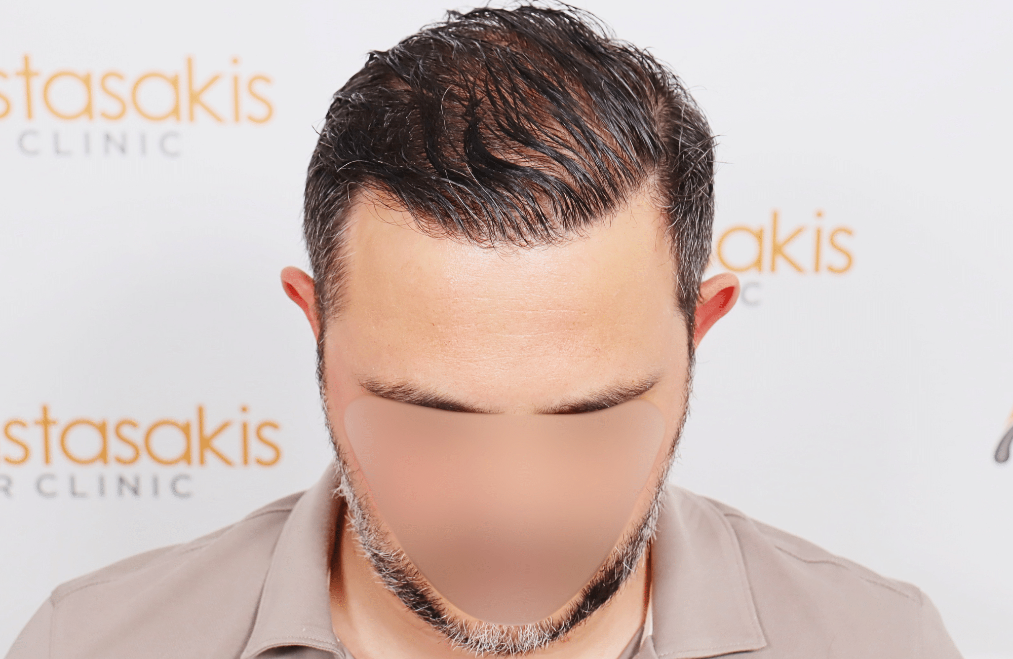 hair transplant result 3500 fus stage 5 (14)