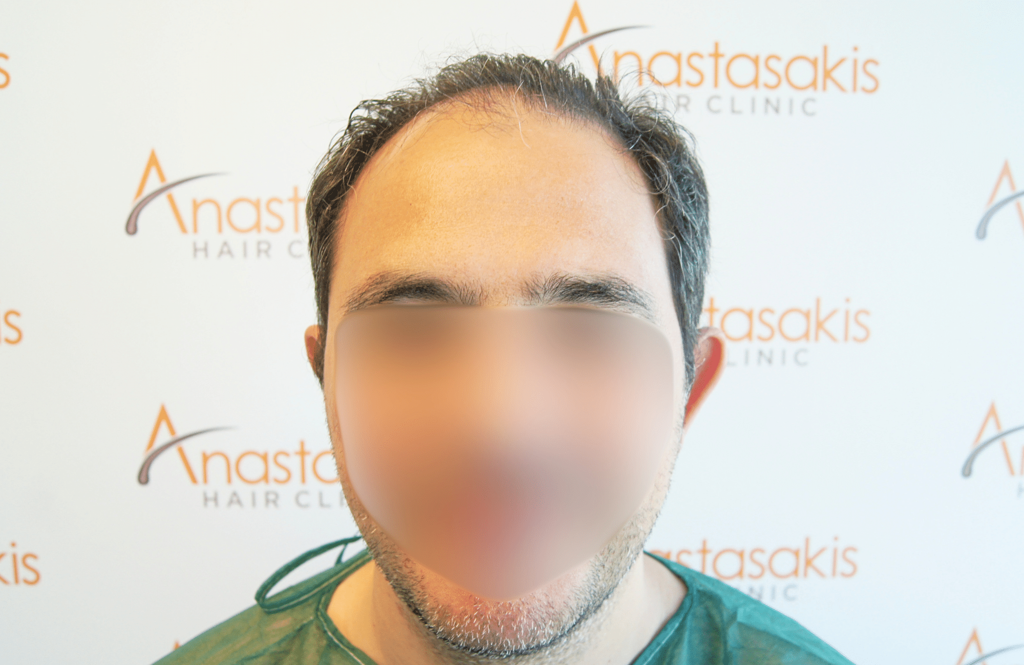 hair transplant result 3500 fus stage 5 (15)