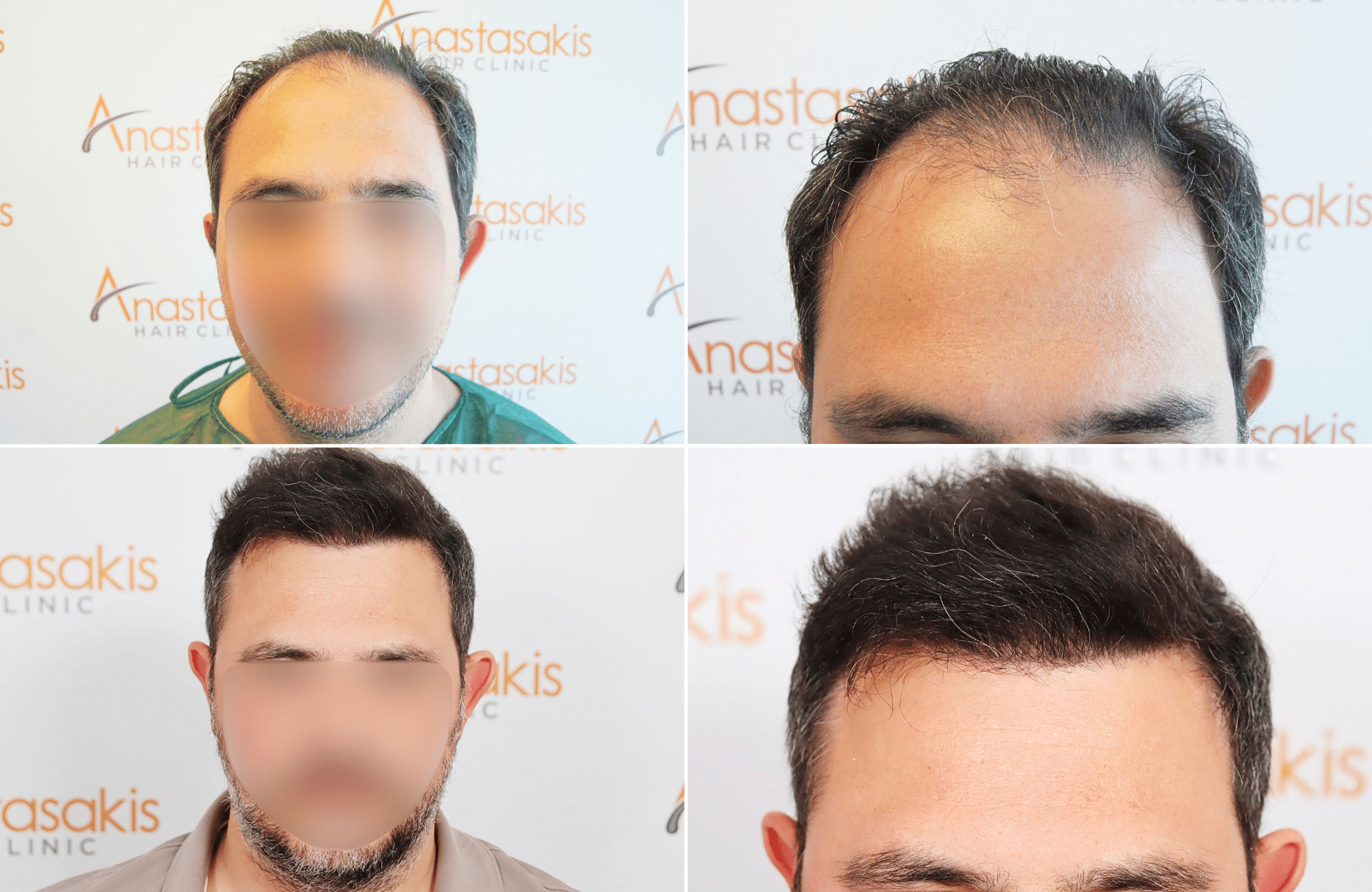 https://www.anastasakishairclinic.gr/portfolio/apotelesma-metamosxefsis-mallion-anastasakis-hair-clinic-47/