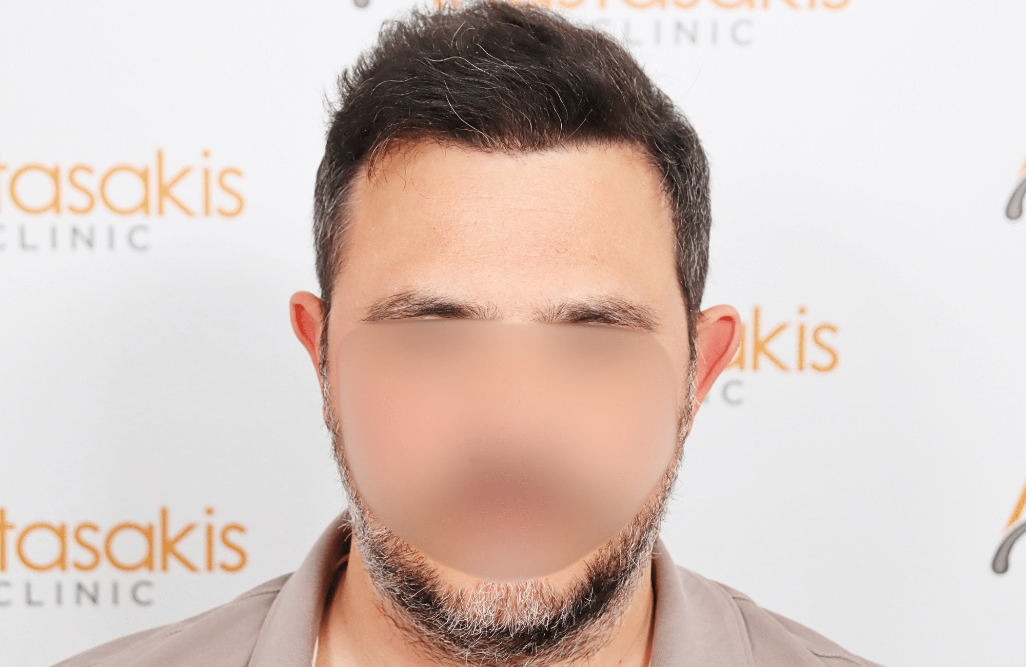 hair transplant result 3500 fus stage 5 (3)