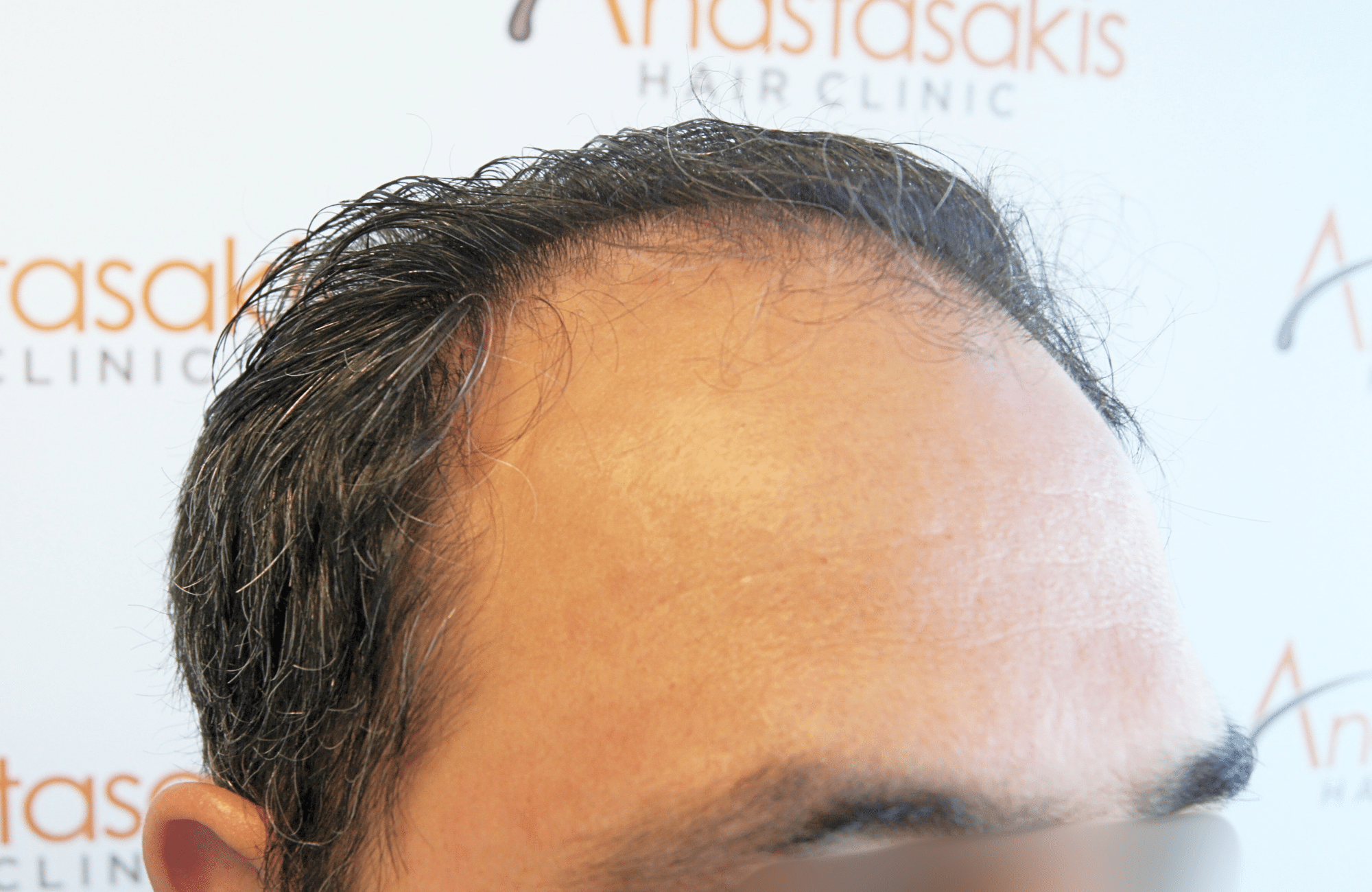 hair transplant result 3500 fus stage 5 (4)