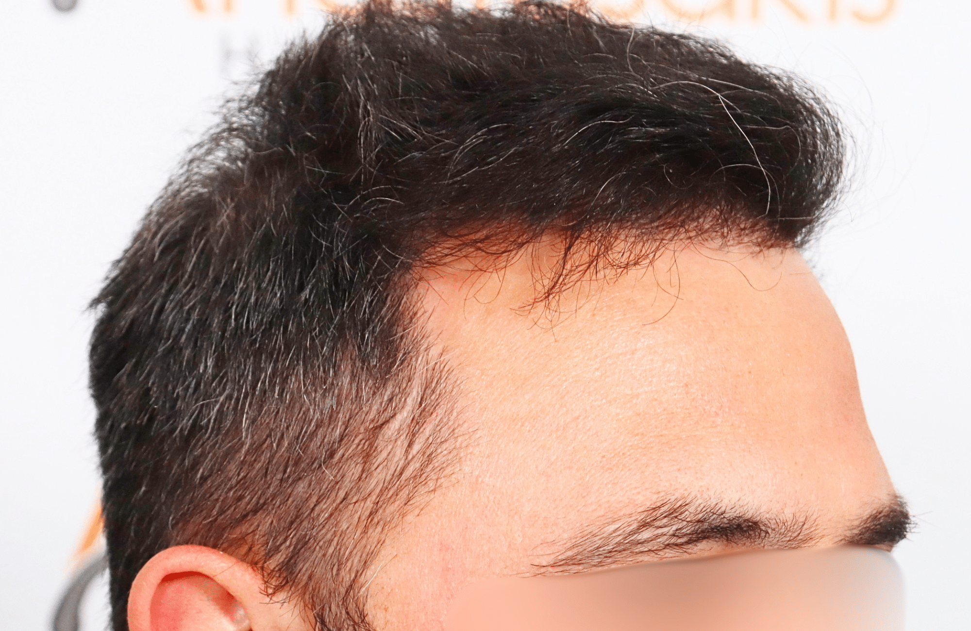 hair transplant result 3500 fus stage 5 (5)