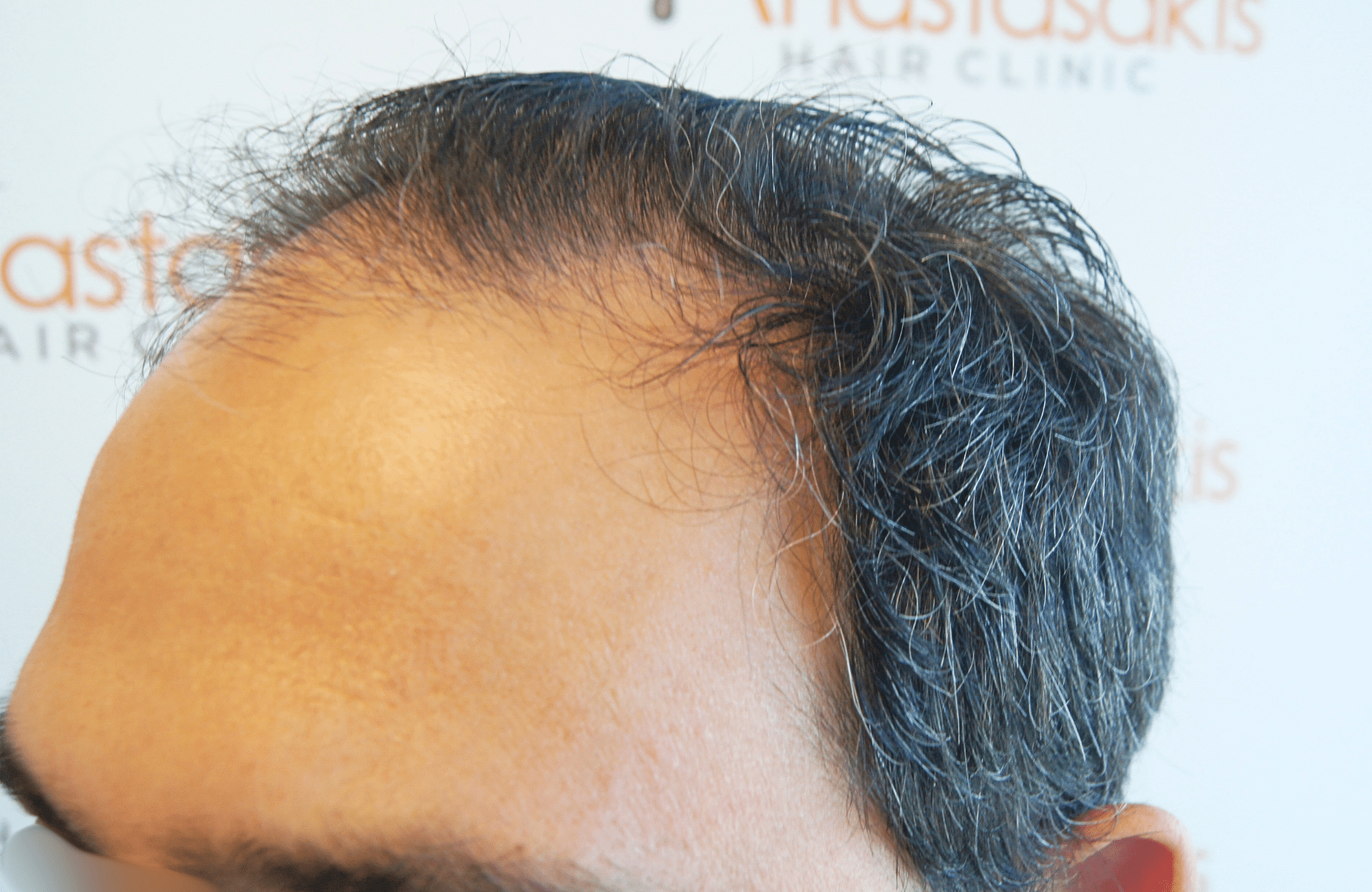 hair transplant result 3500 fus stage 5 (6)