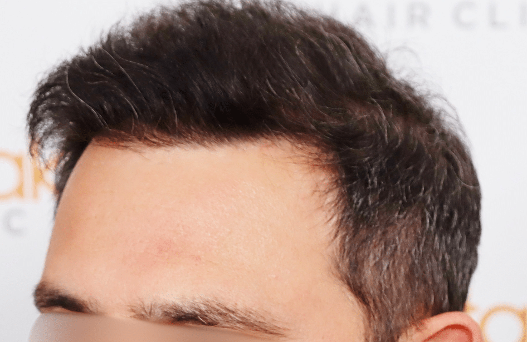 hair transplant result 3500 fus stage 5 (7)
