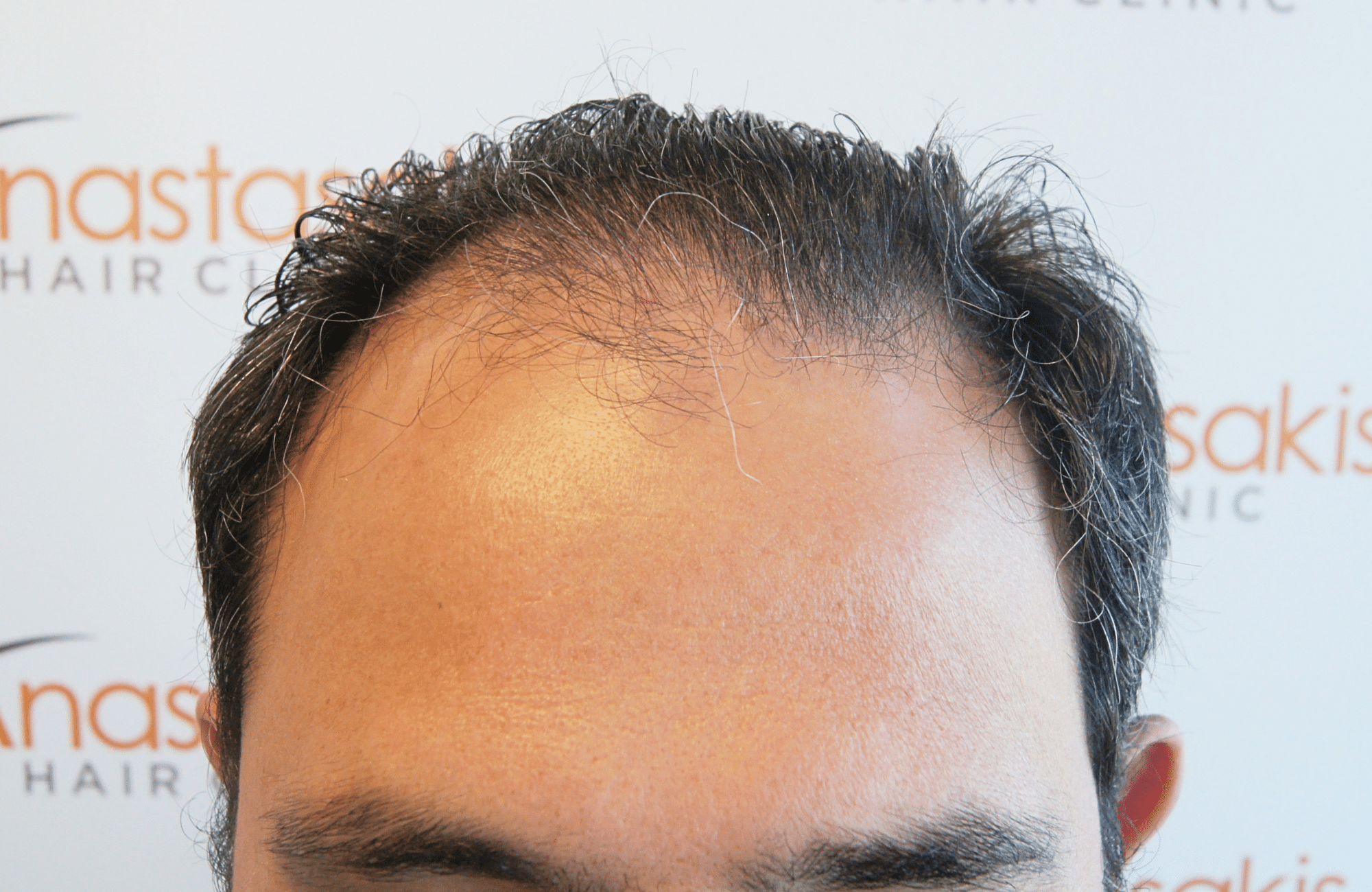 hair transplant result 3500 fus stage 5 (8)