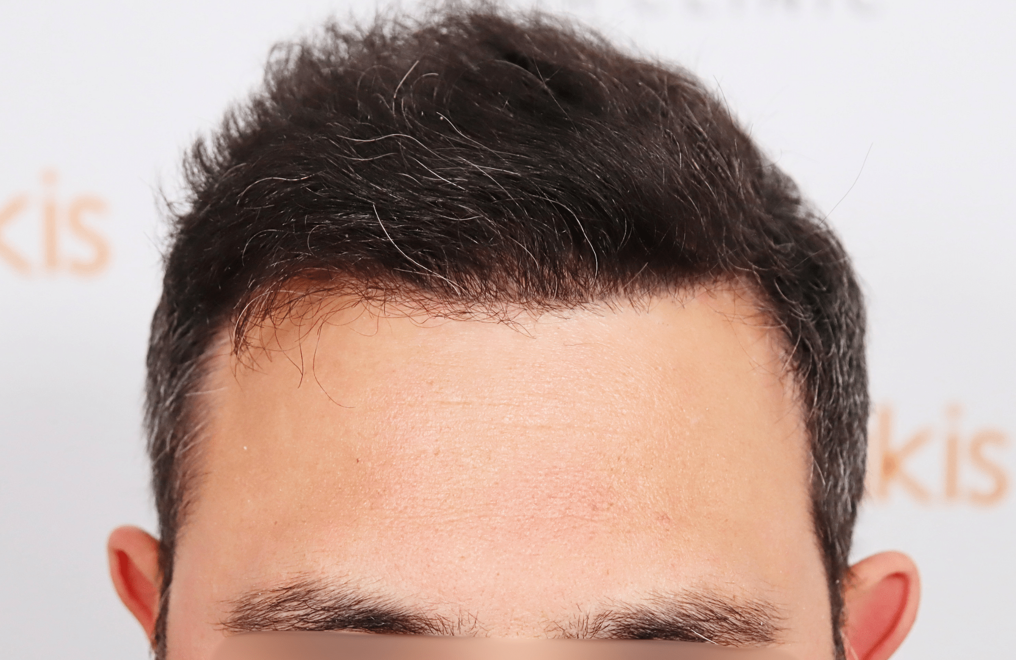 hair transplant result 3500 fus stage 5 (9)