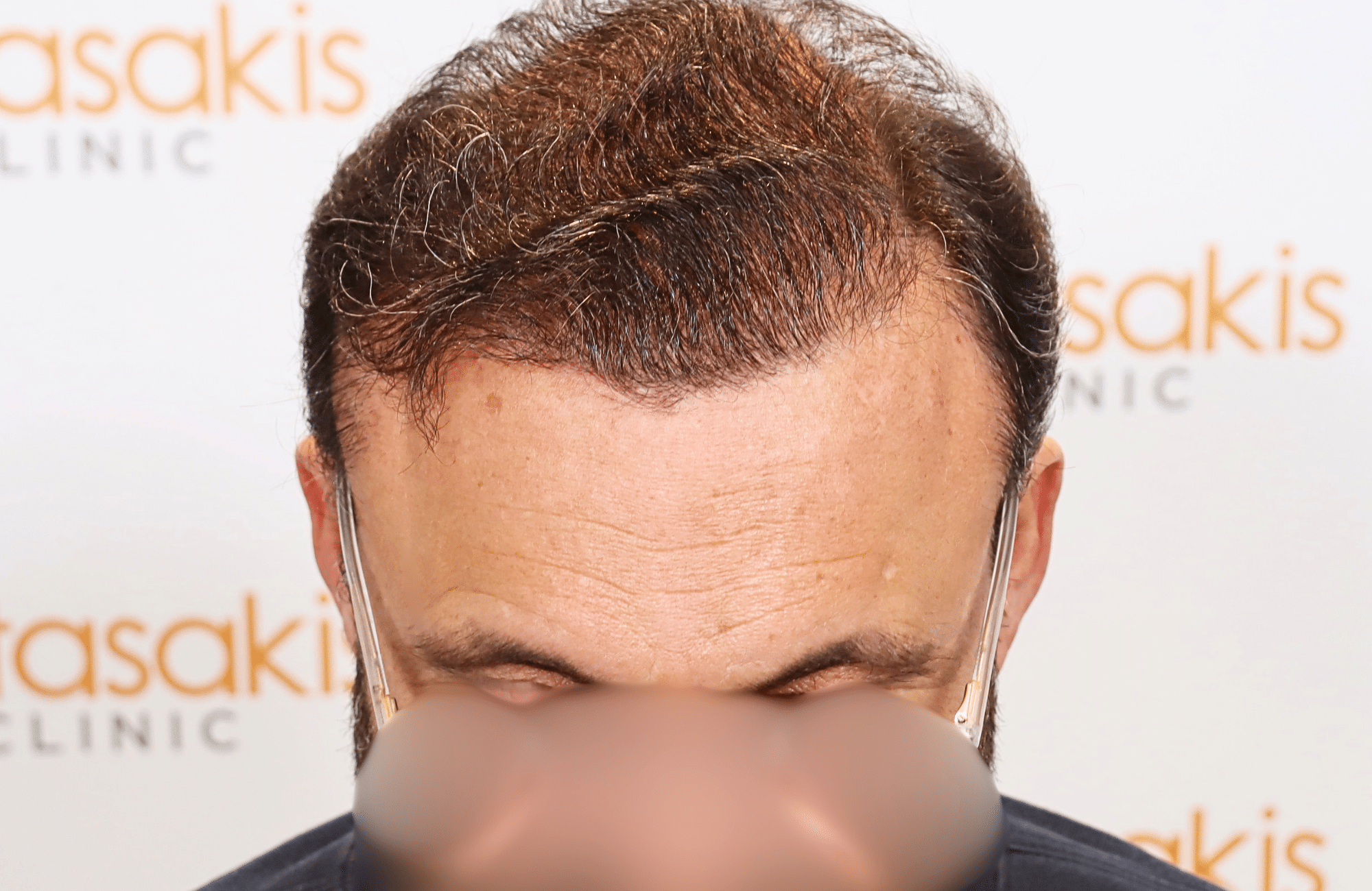hair transplant result 3500 fus stage 7 thin (1)