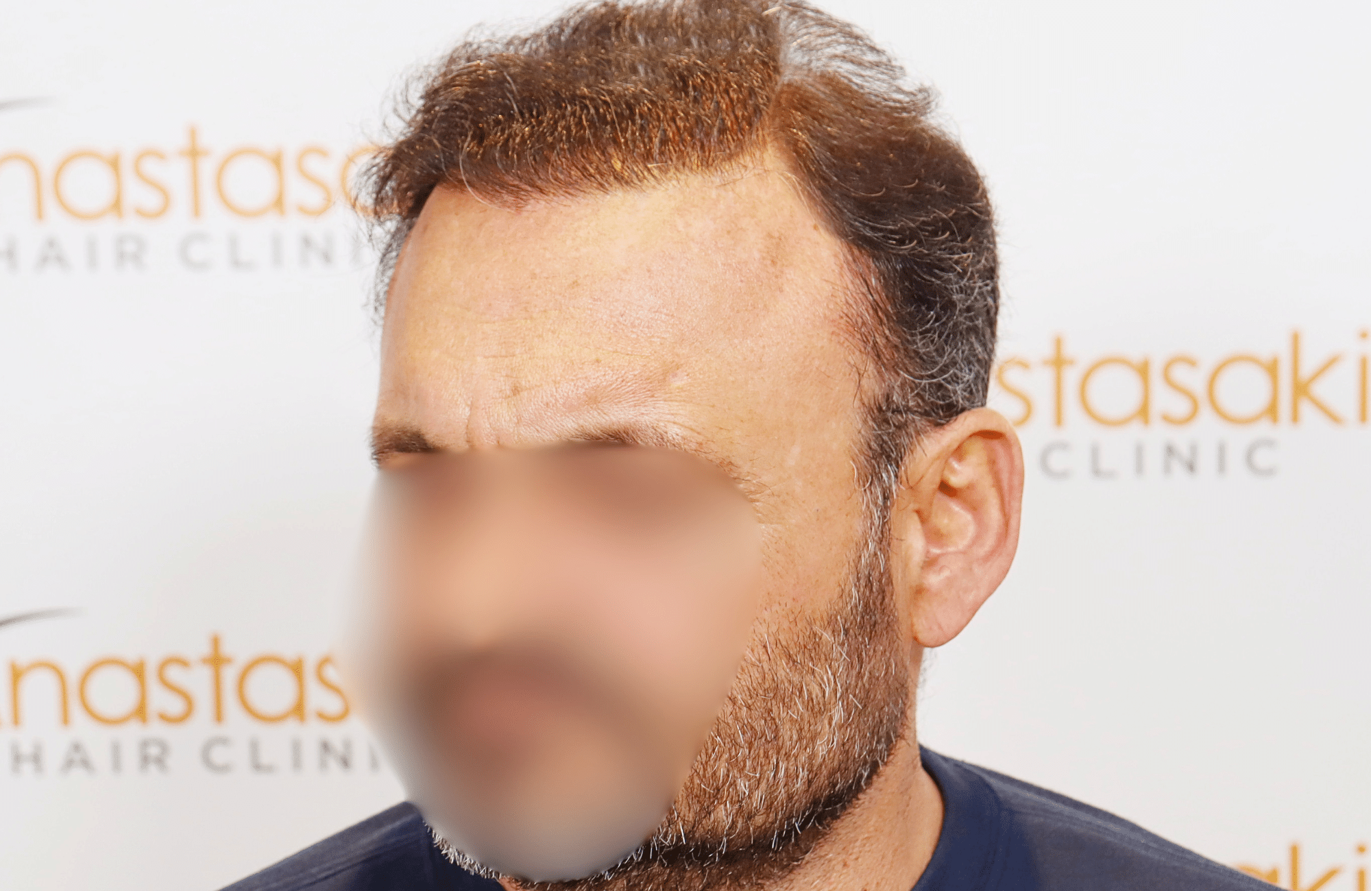 hair transplant result 3500 fus stage 7 thin