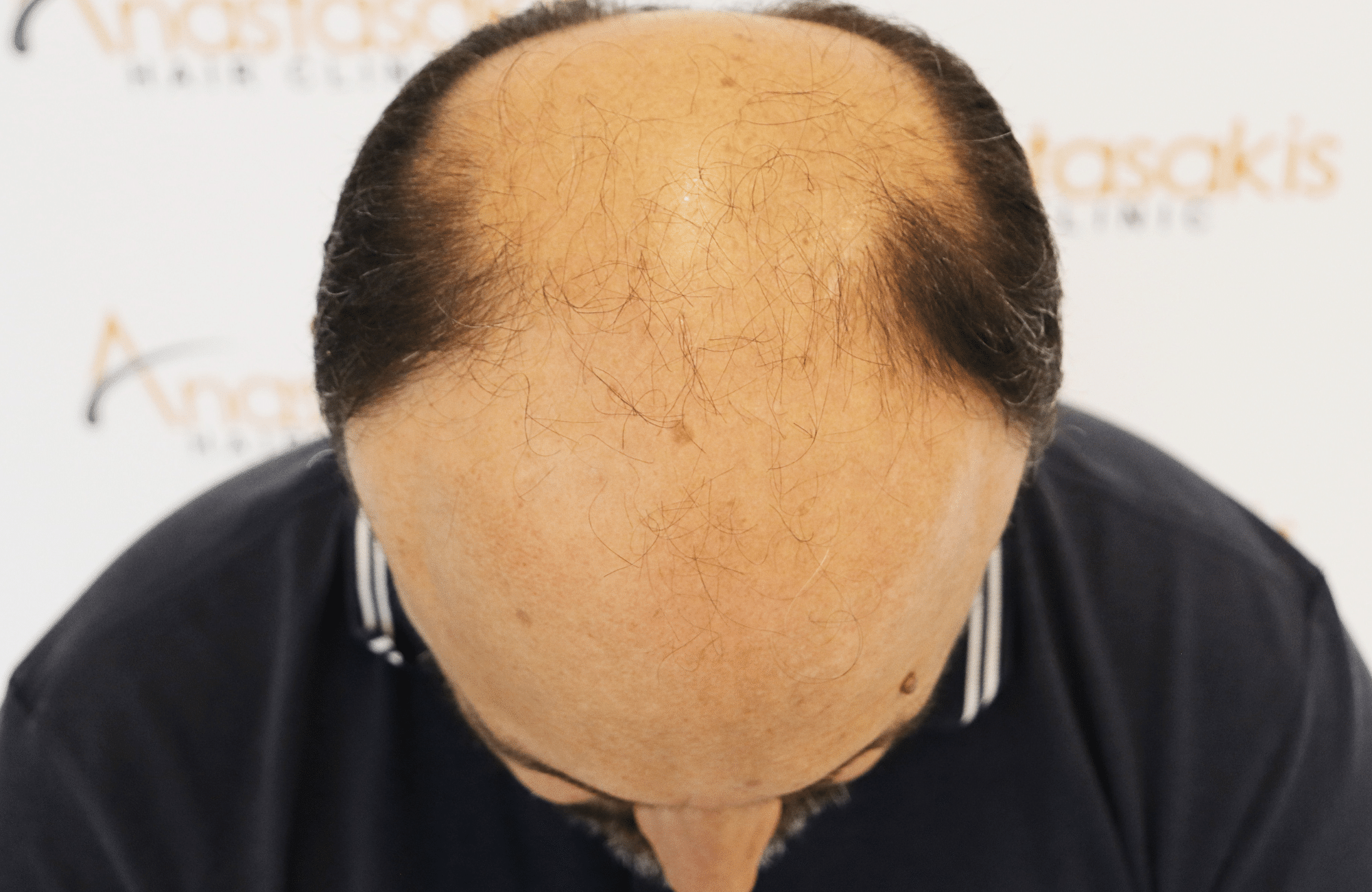 hair transplant result 3500 fus stage 7 thin (6)