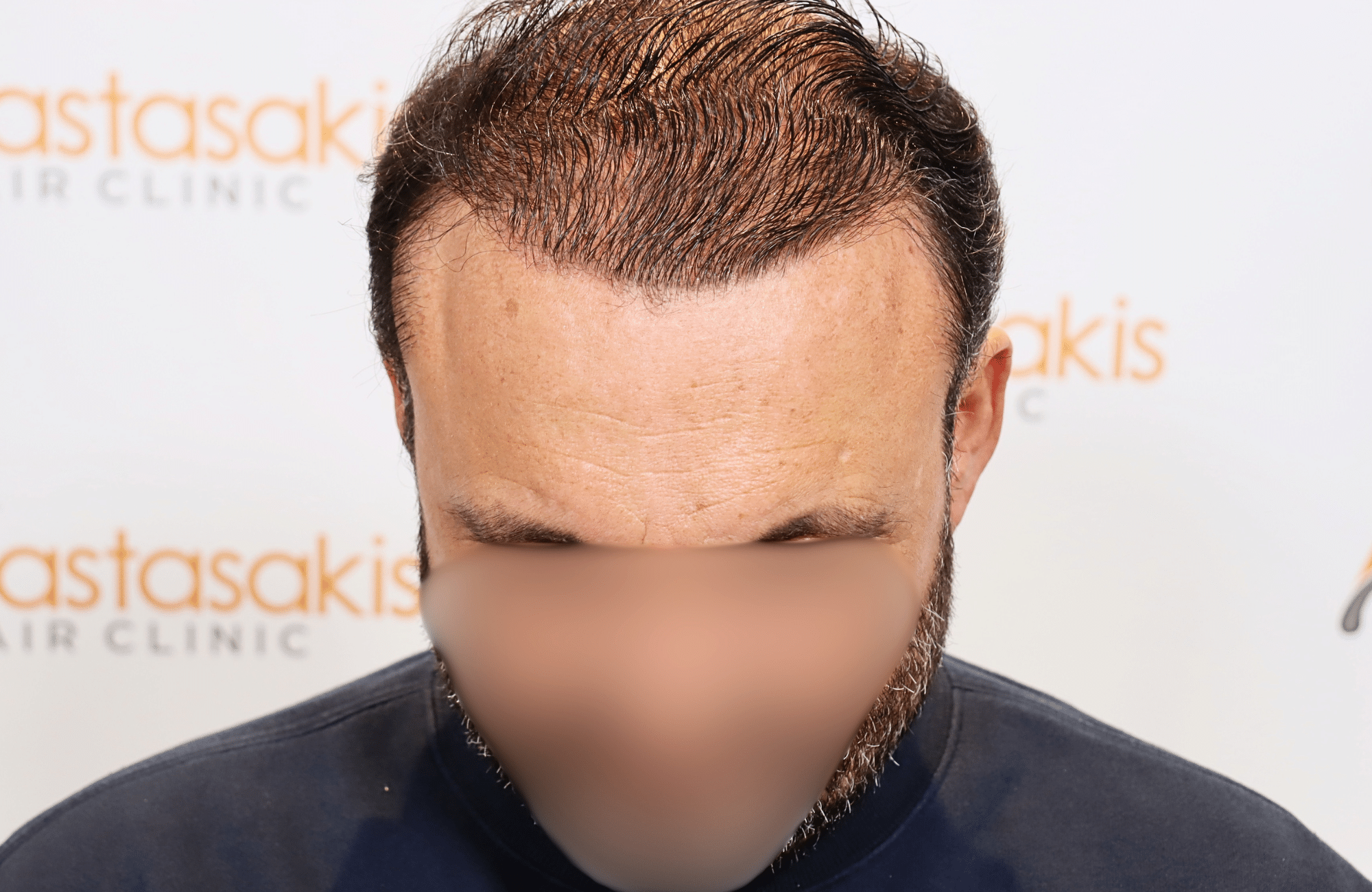 hair transplant result 3500 fus stage 7 thin wet hair