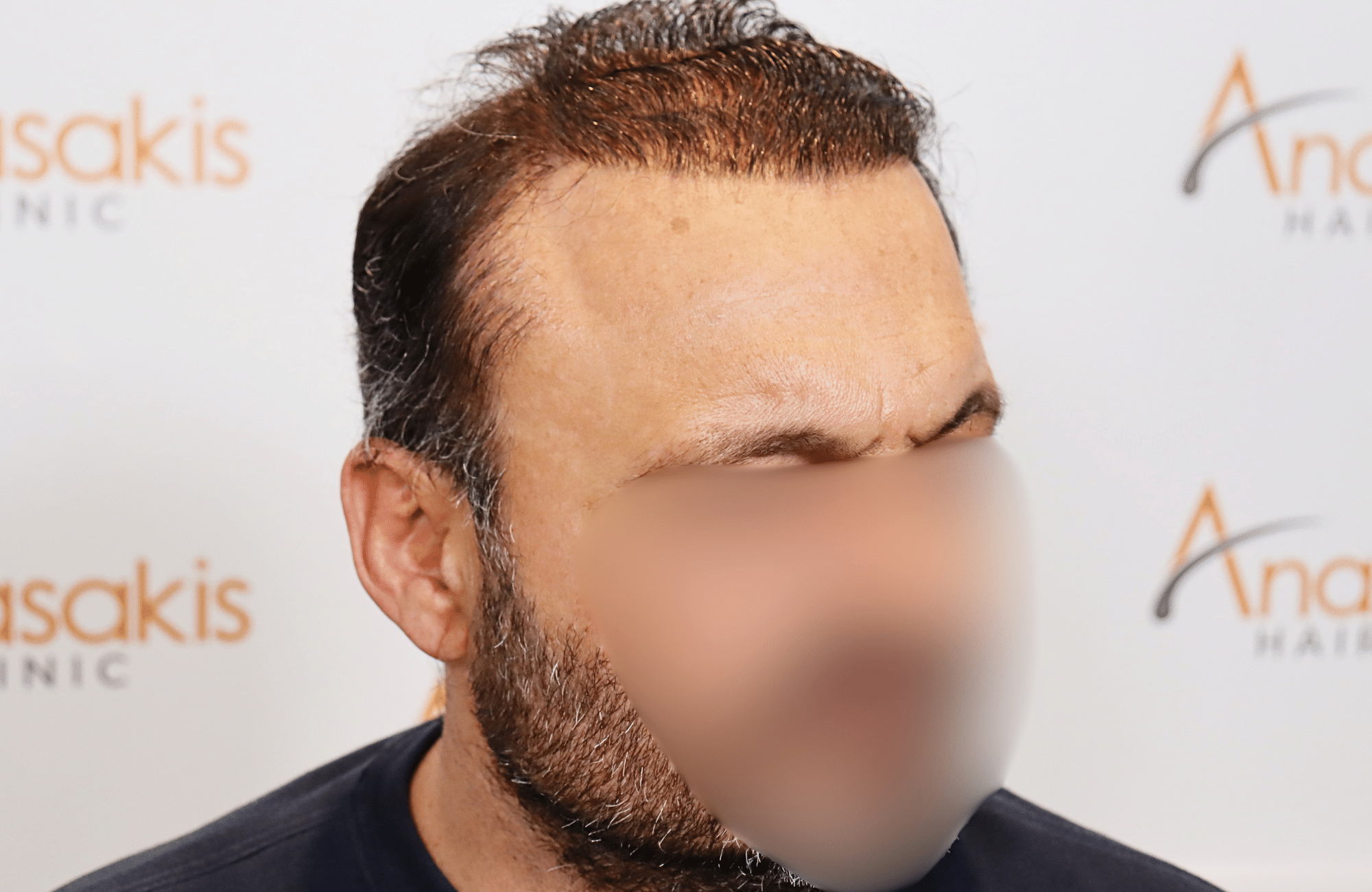 hair transplant result 3500 fus stage 7 thin