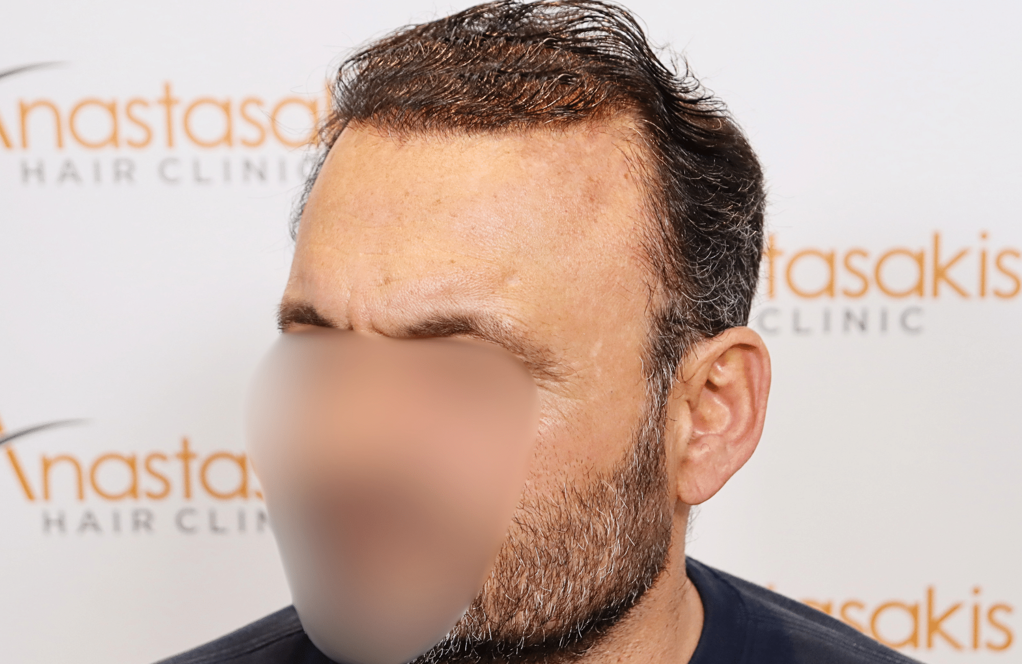 hair transplant result 3500 fus stage 7 thin