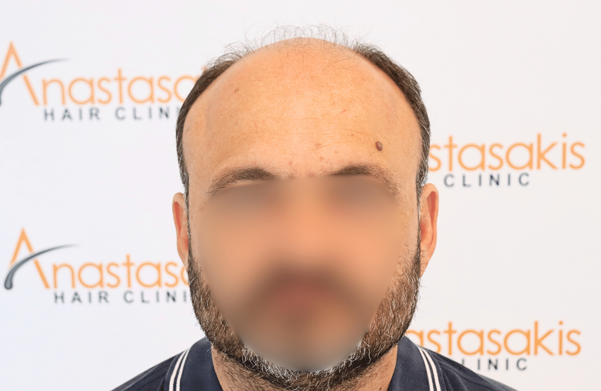 haor transplant result 3500 fus