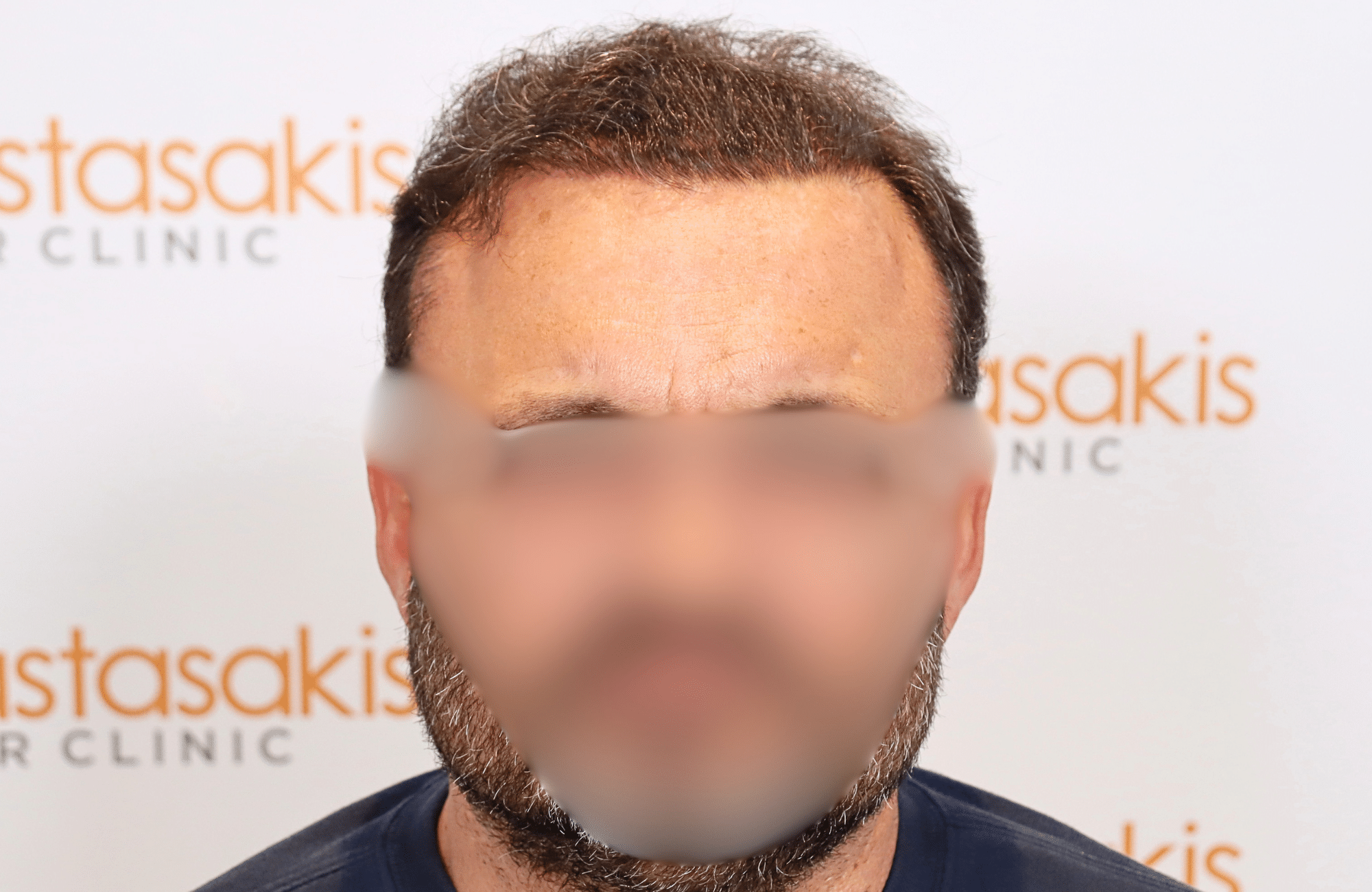 hair transplant result 3500 fus stage 7 thin (6)
