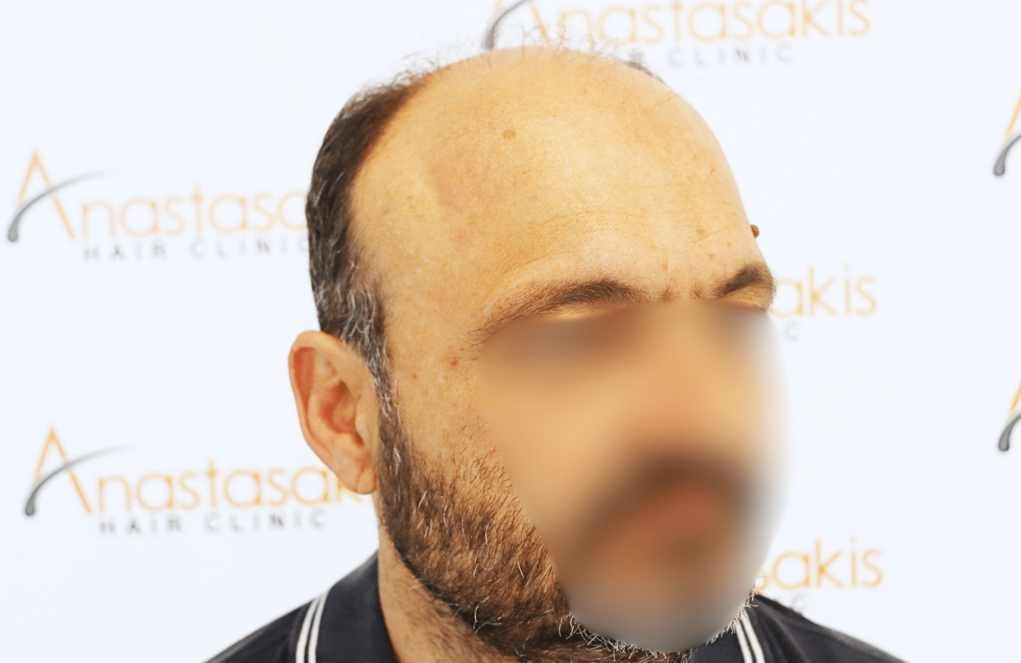hair transplant result 3500 fus stage 7 thin
