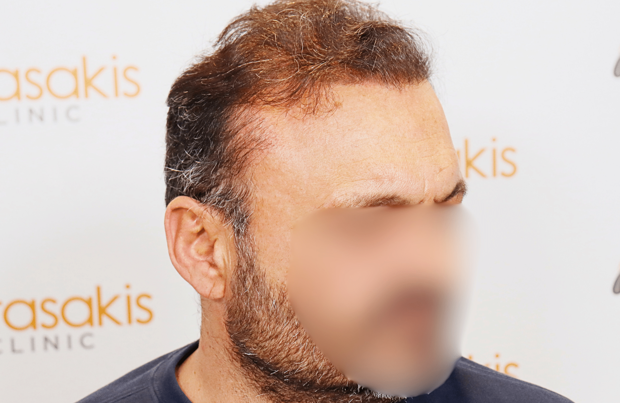 hair transplant result 3500 fus stage 7 thin