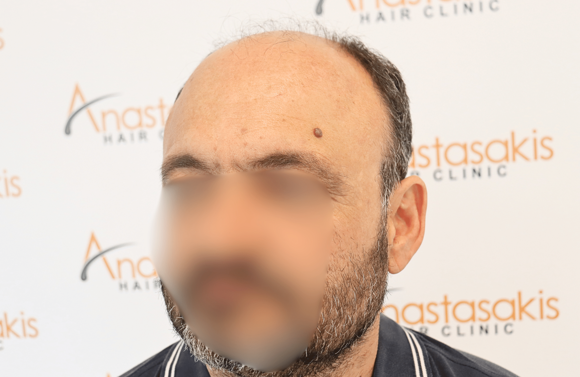 hair transplant result 3500 fus stage 7 thin