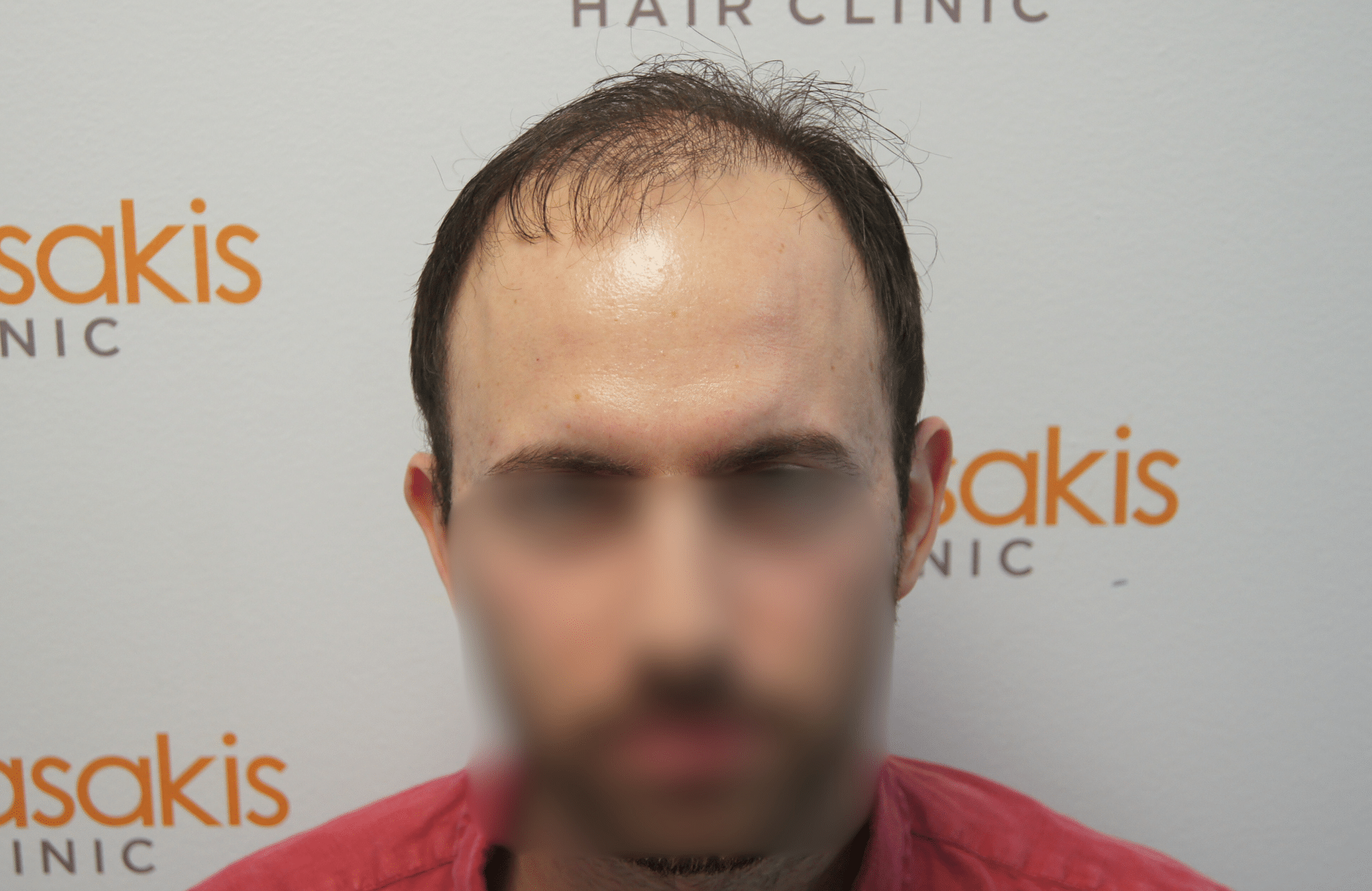hair transplant result