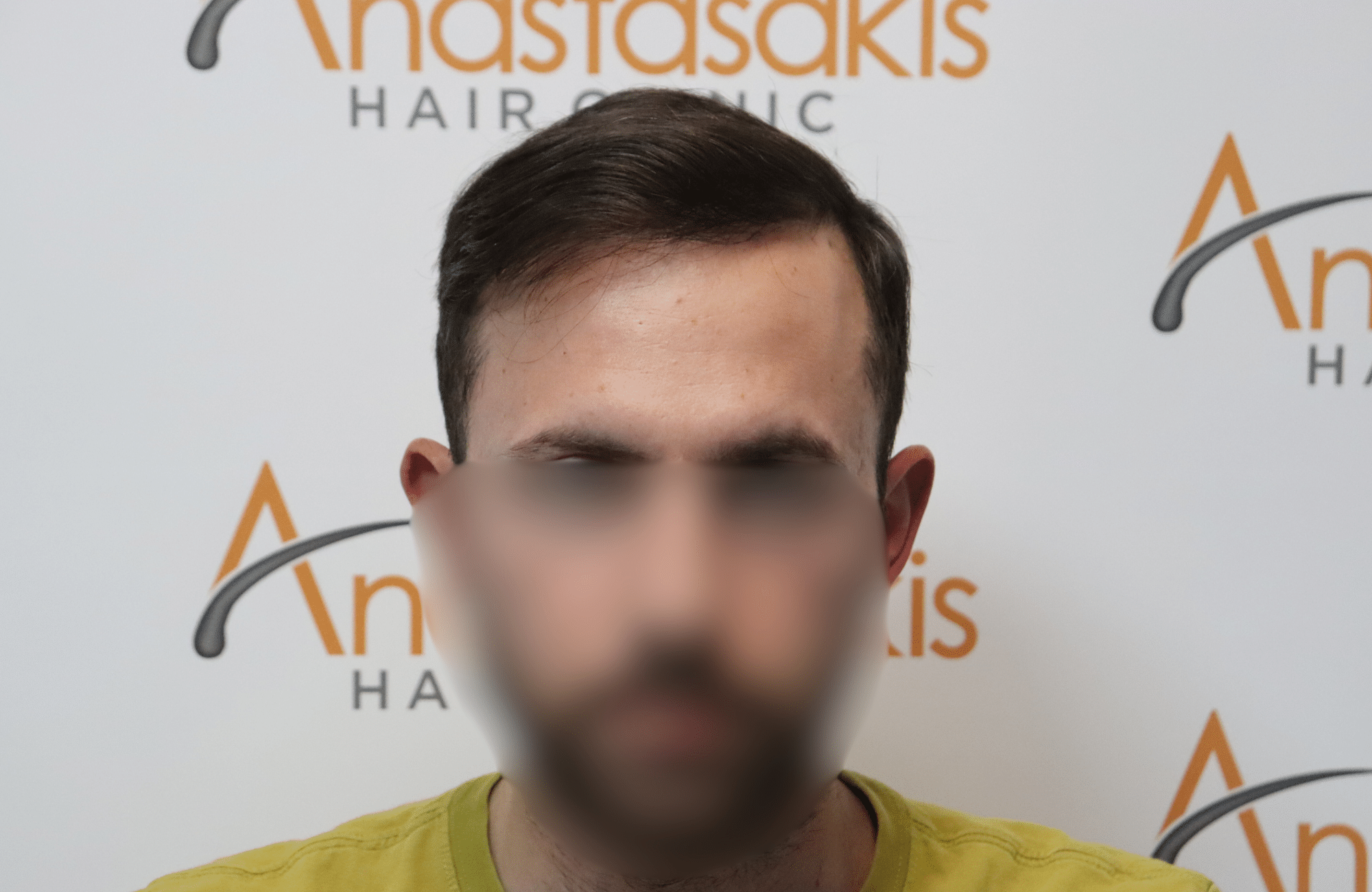 hair transplant result