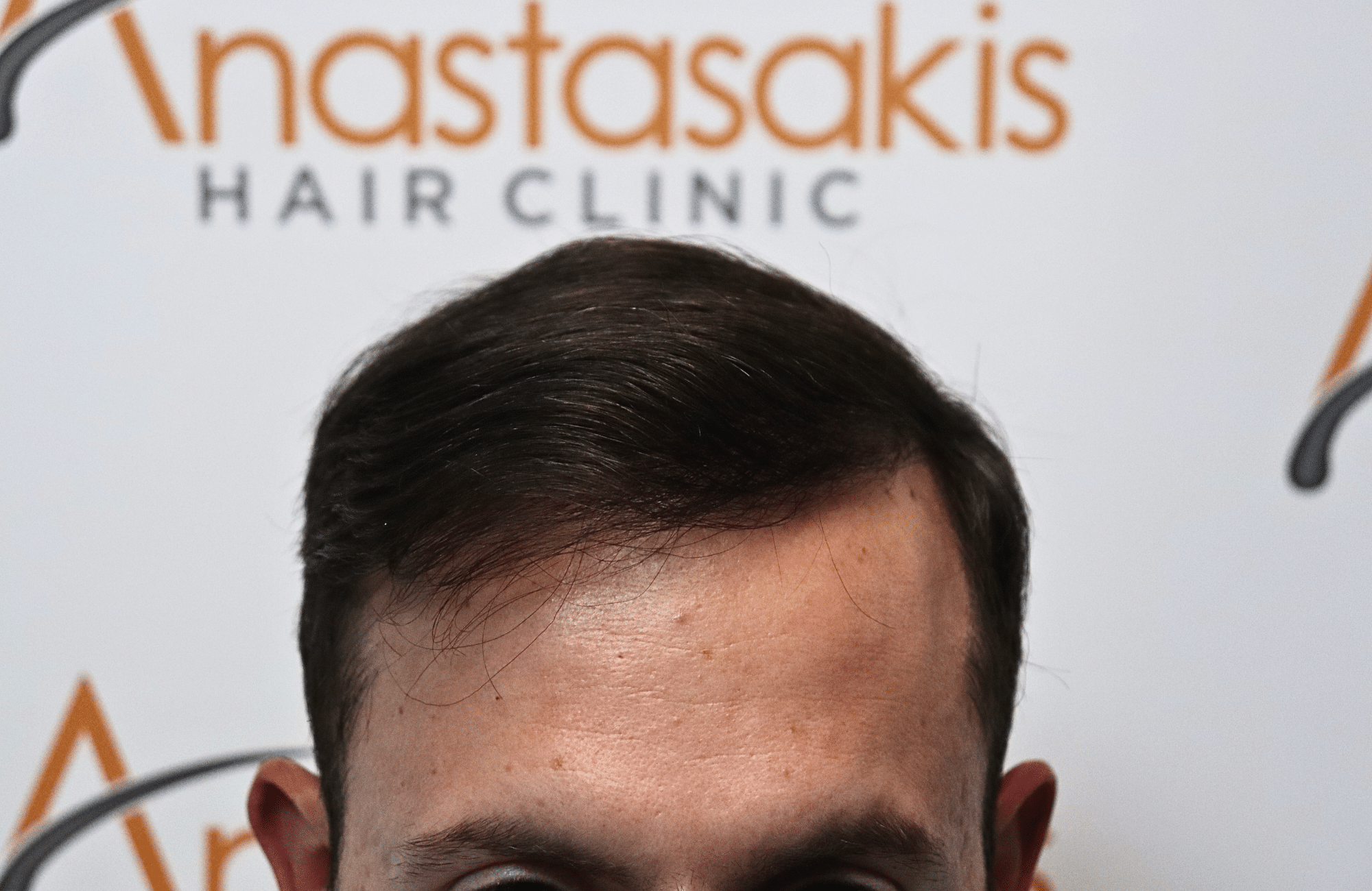 hair transplant result