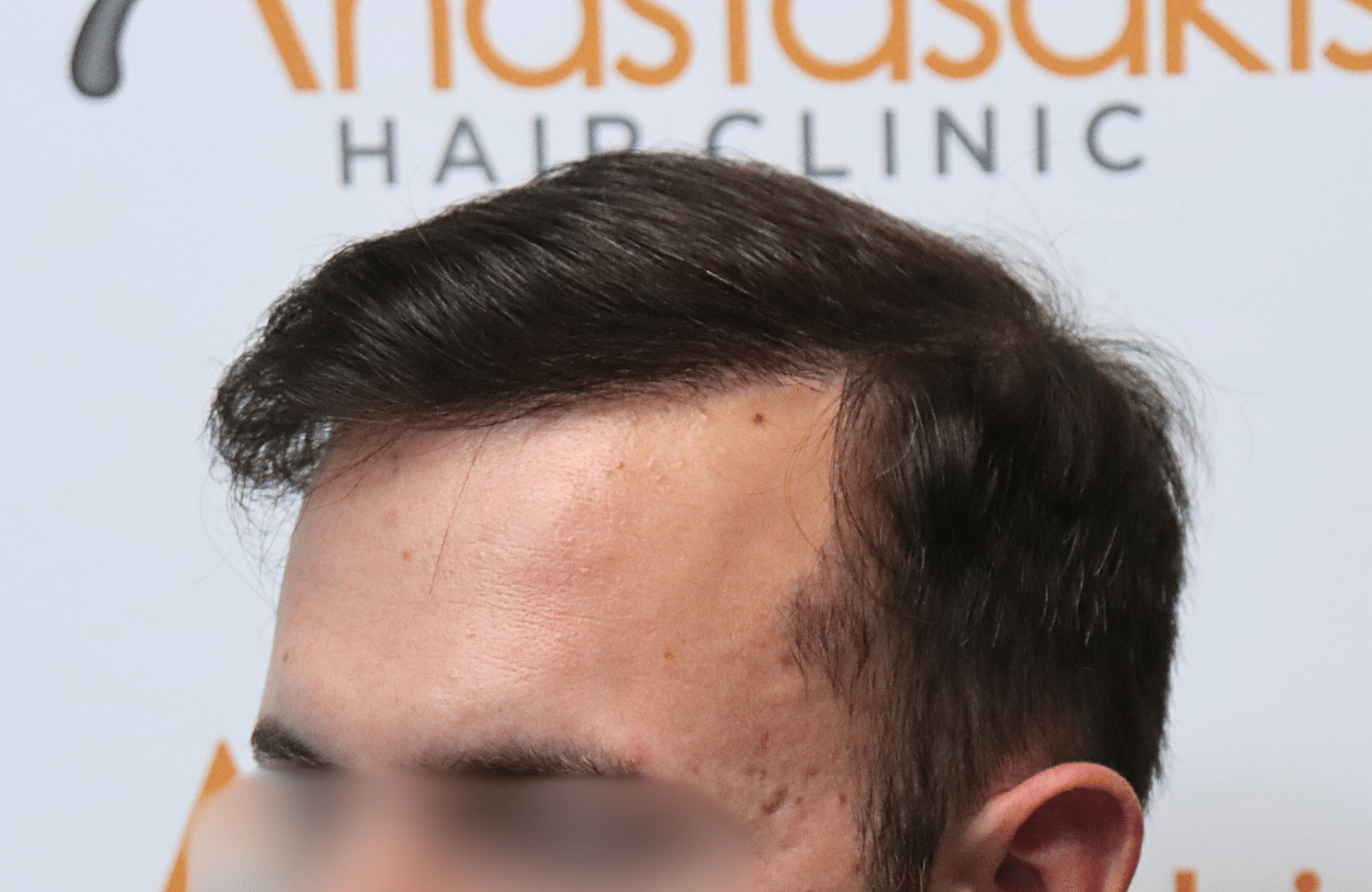 hair transplant result