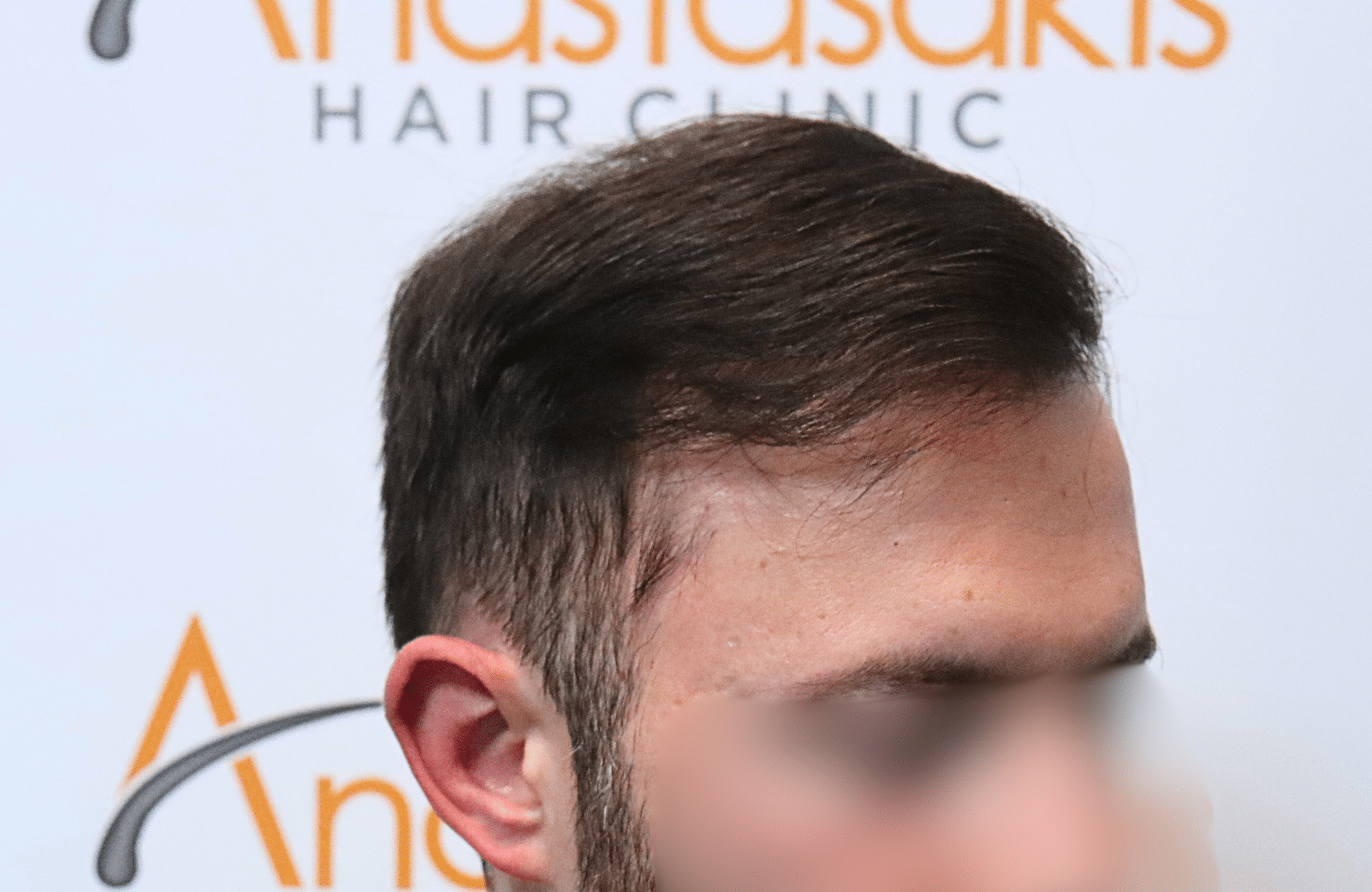 hair transplant result
