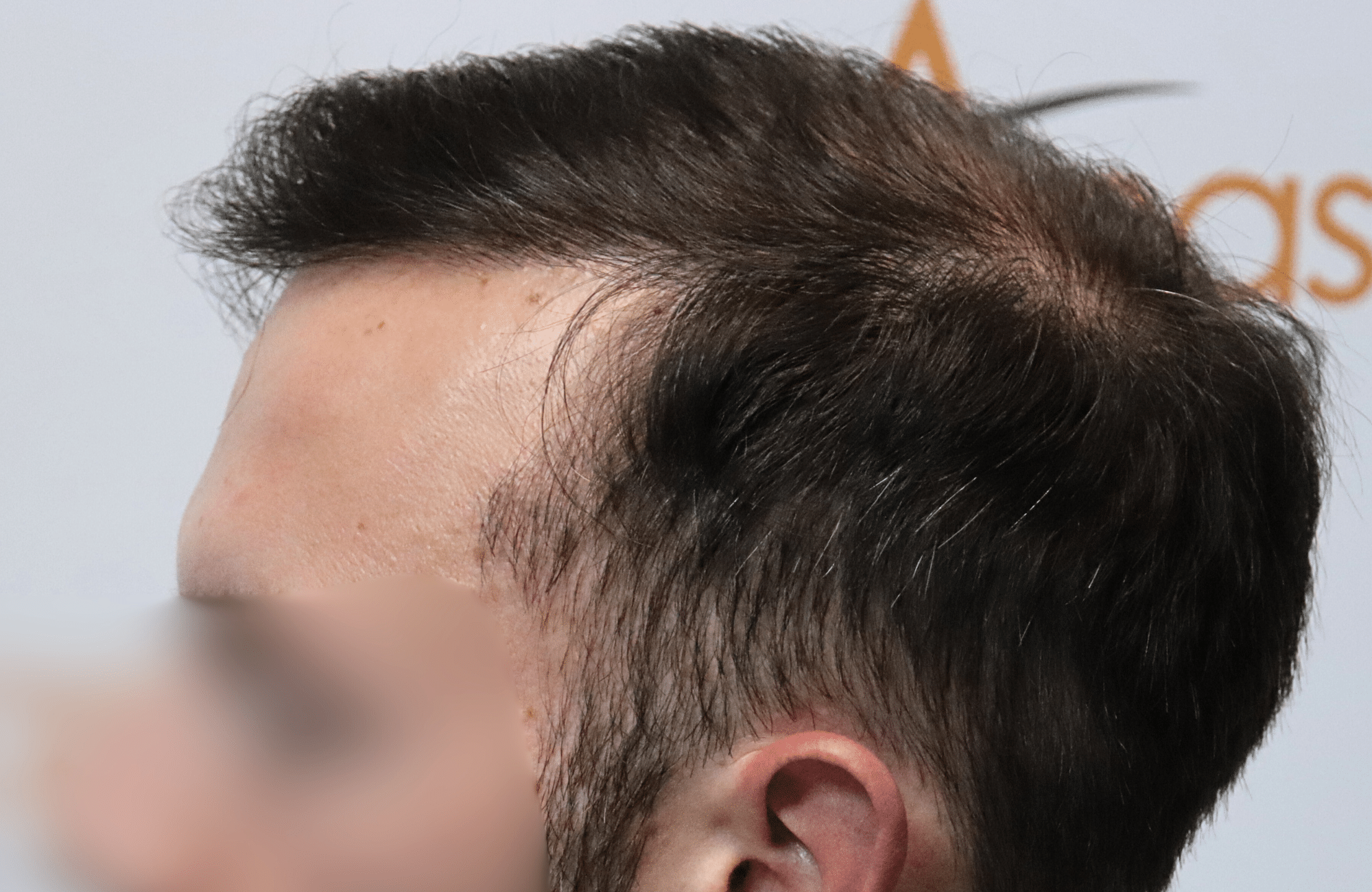 hair transplant result
