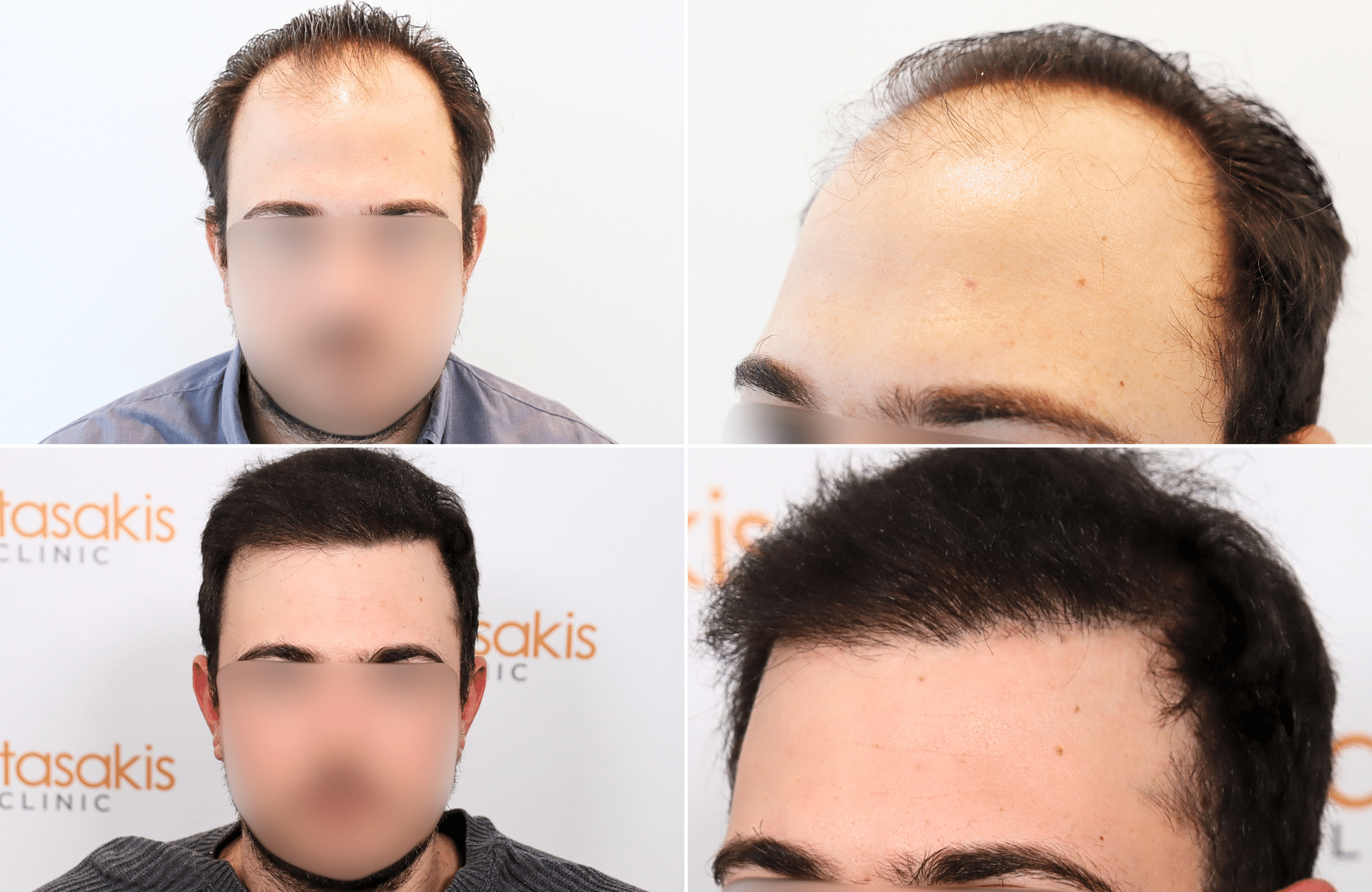 https://www.anastasakishairclinic.gr/portfolio/apotelesma-metamosxefsis-mallion-anastasakis-hair-clinic-125/
