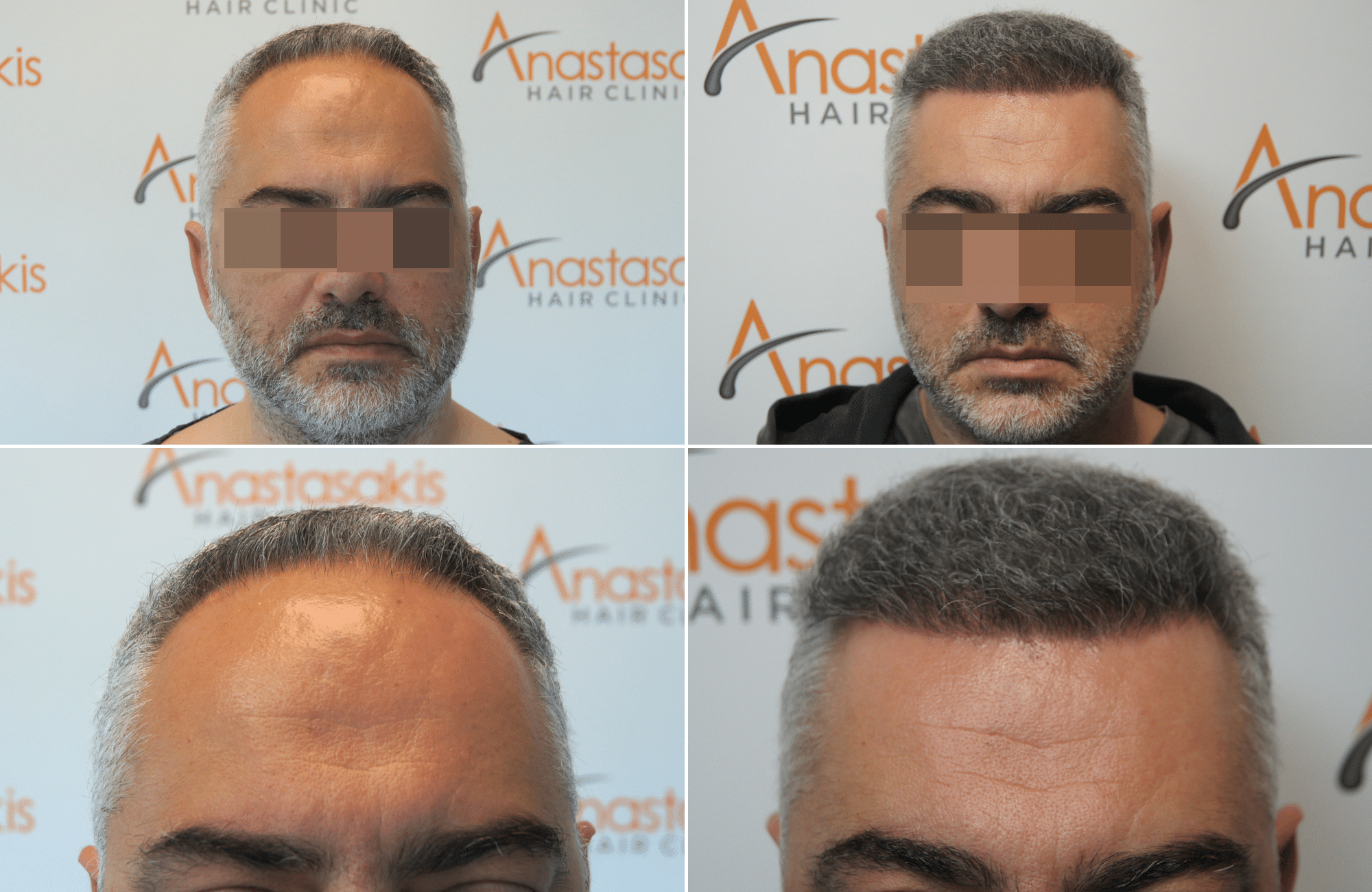 https://www.anastasakishairclinic.gr/portfolio/apotelesma-metamosxefsis-mallion-anastasakis-hair-clinic-34/