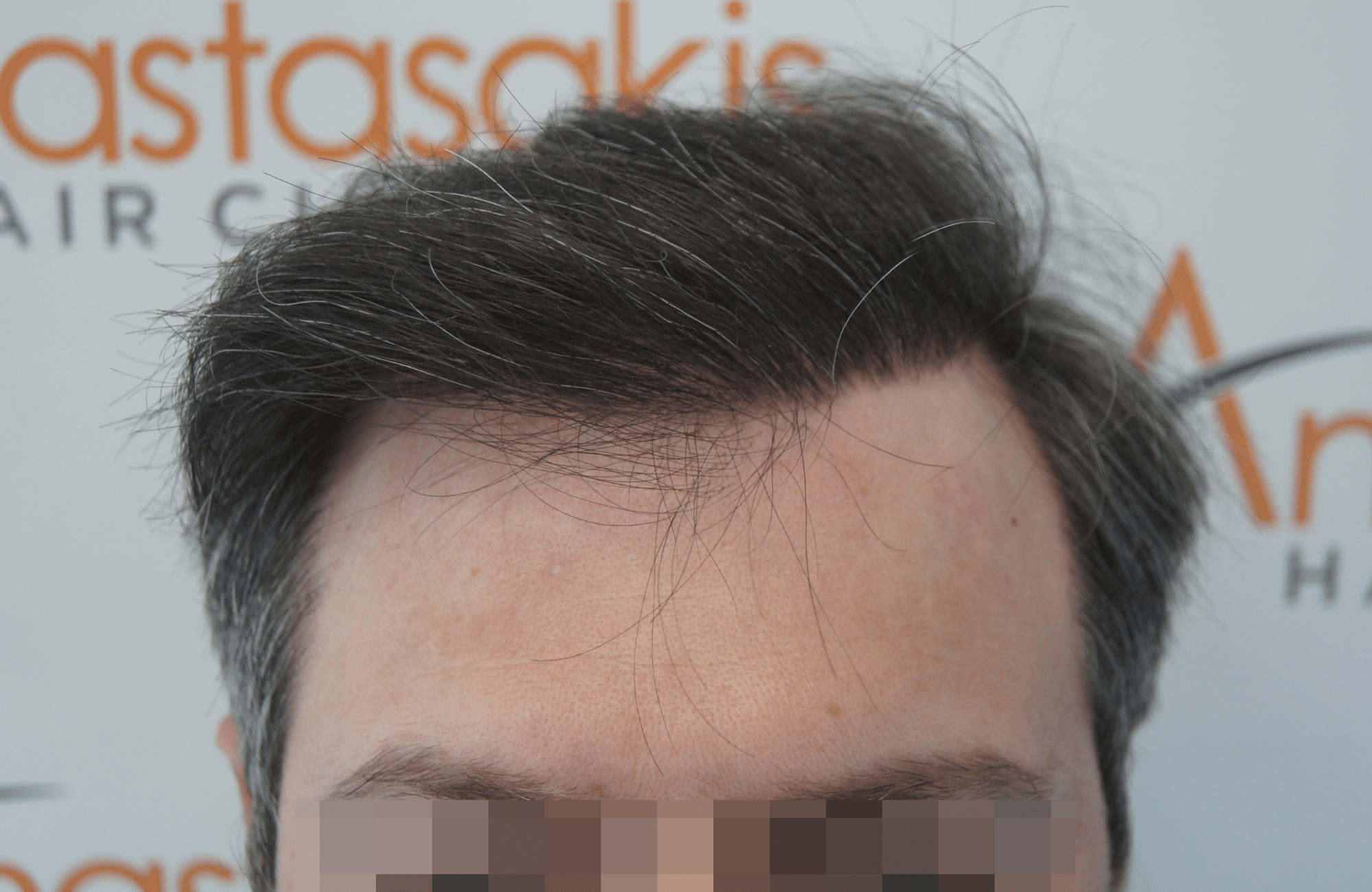 hair transplant result with 2500 follicular units anastasakis hair clinic