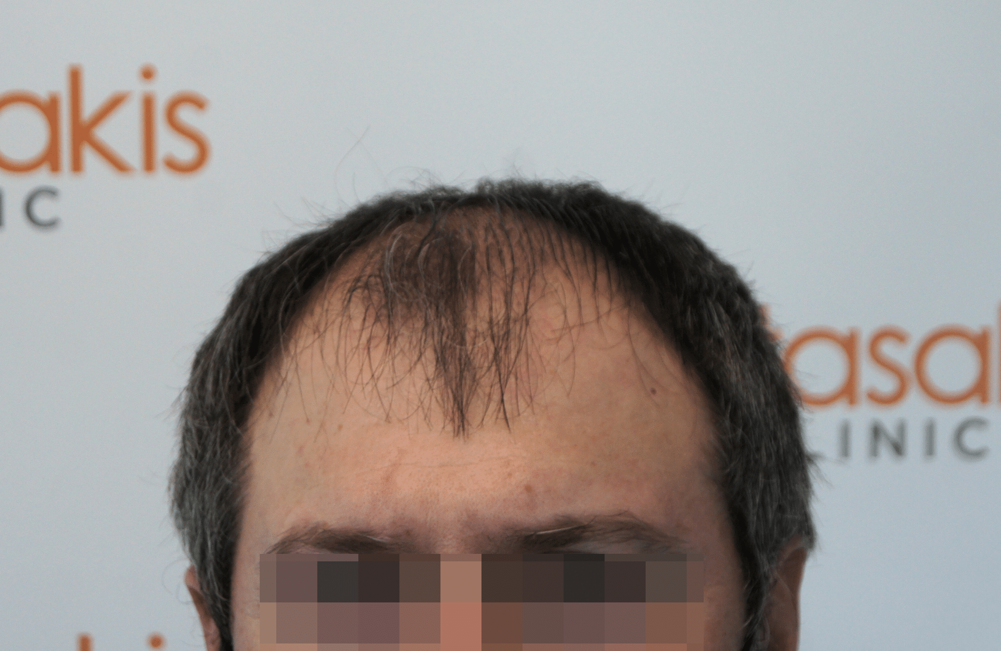 hair transplant result with 2500 follicular units anastasakis hair clinic