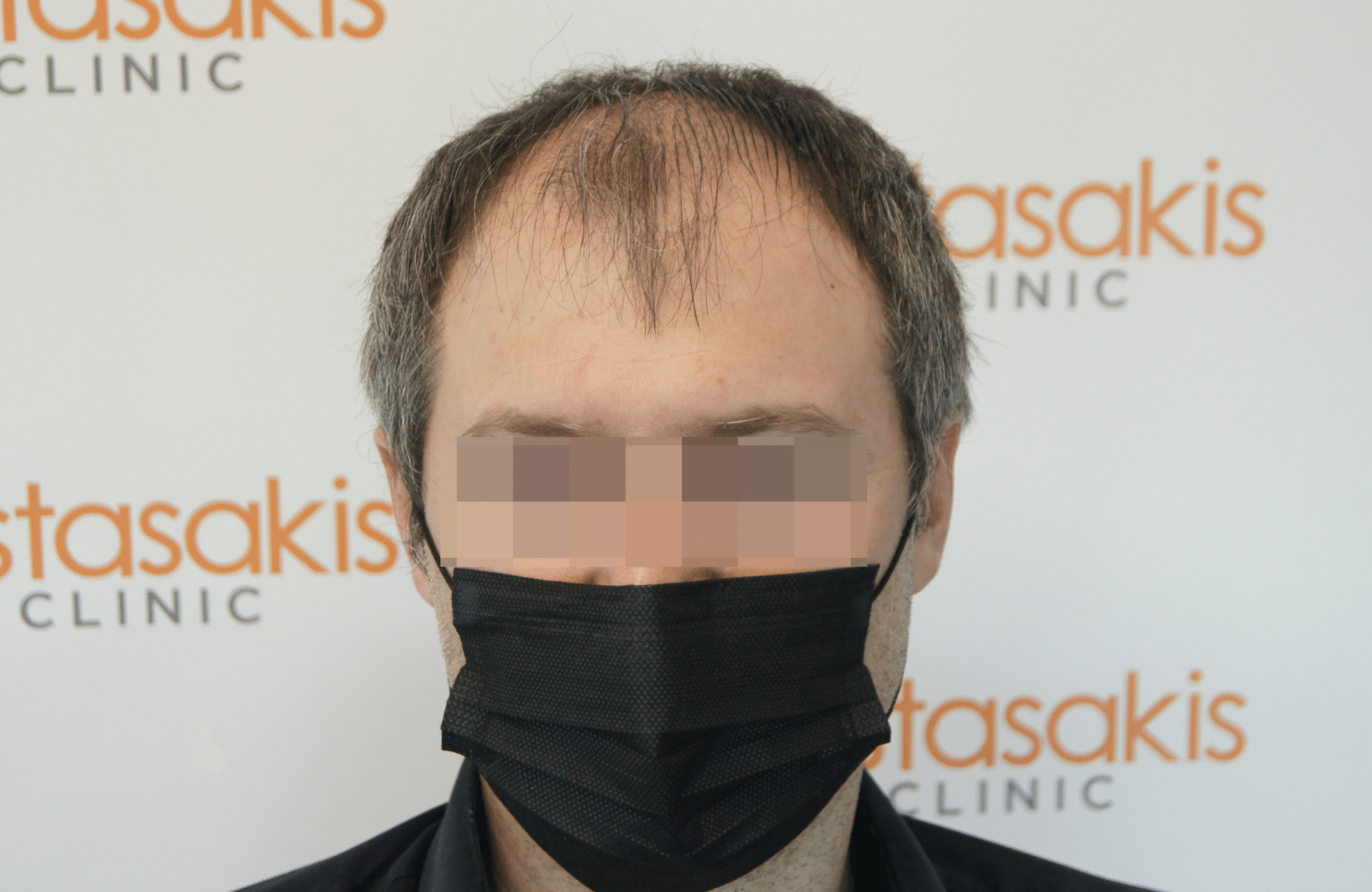hair transplant result with 2500 follicular units anastasakis hair clinic