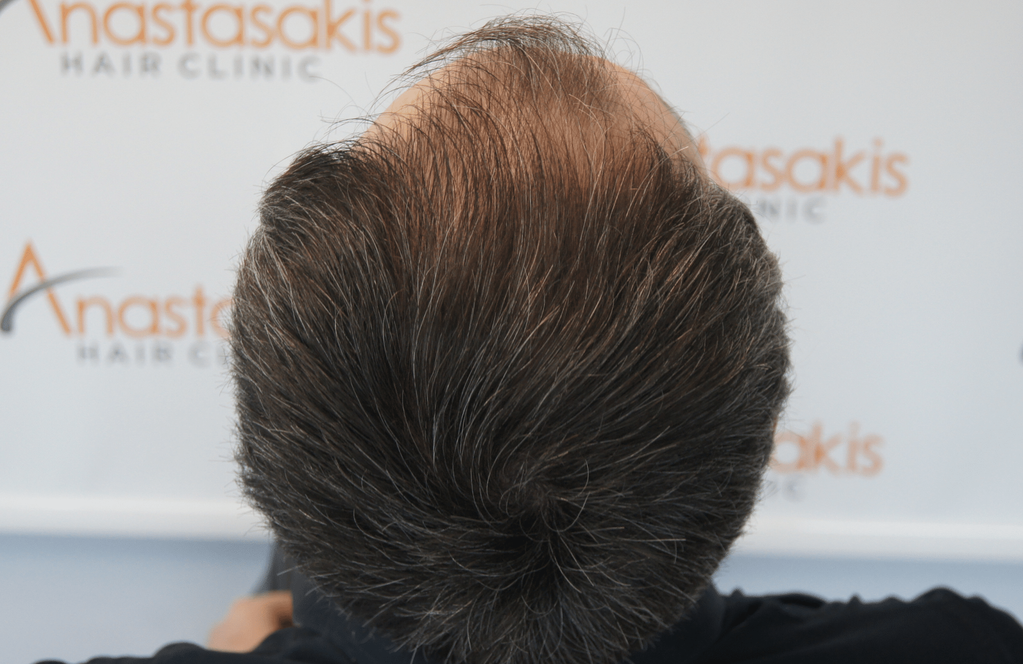 hair transplant result with 2500 follicular units anastasakis hair clinic
