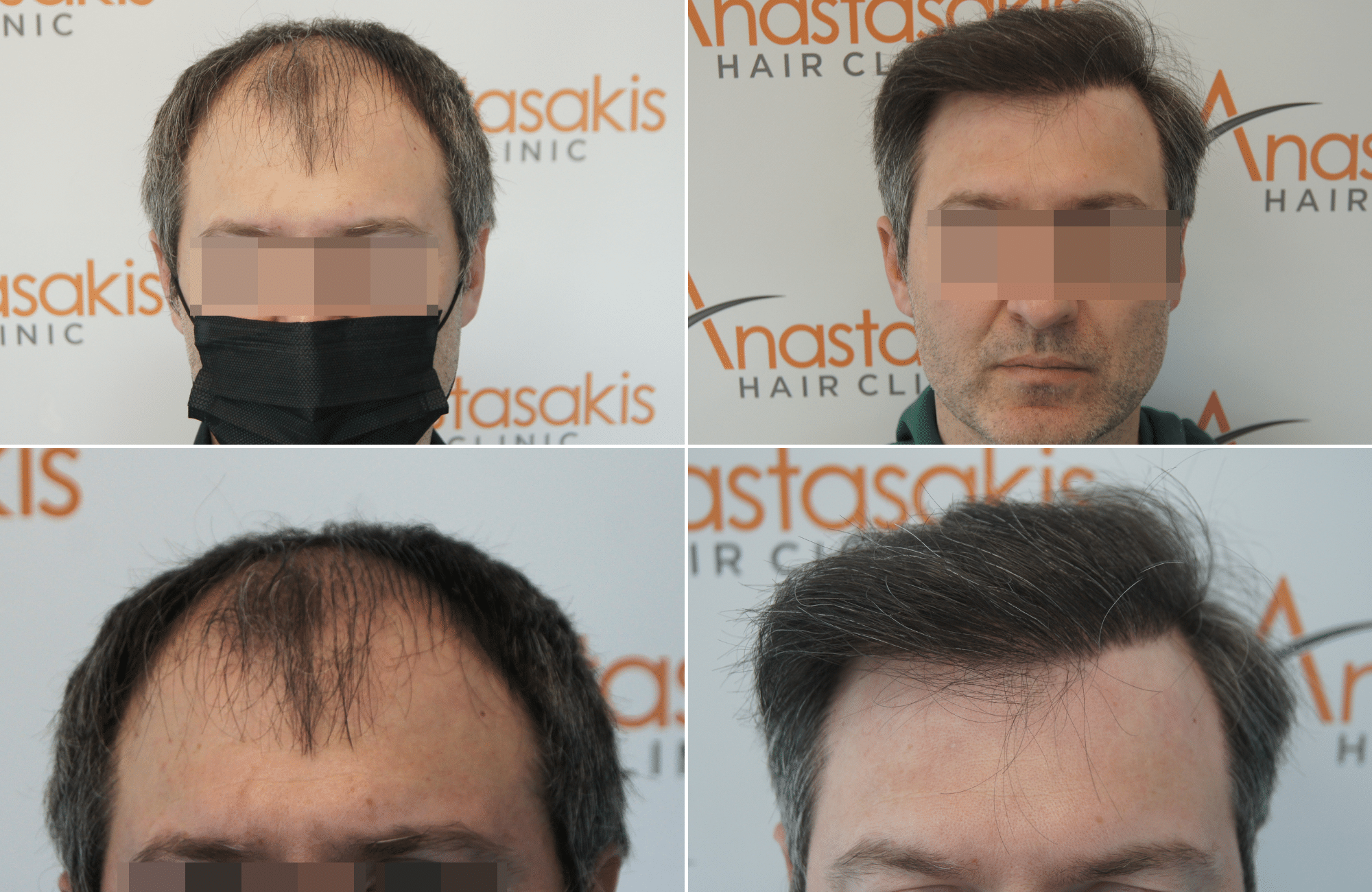 hair transplant result with 2500 follicular units anastasakis hair clinic