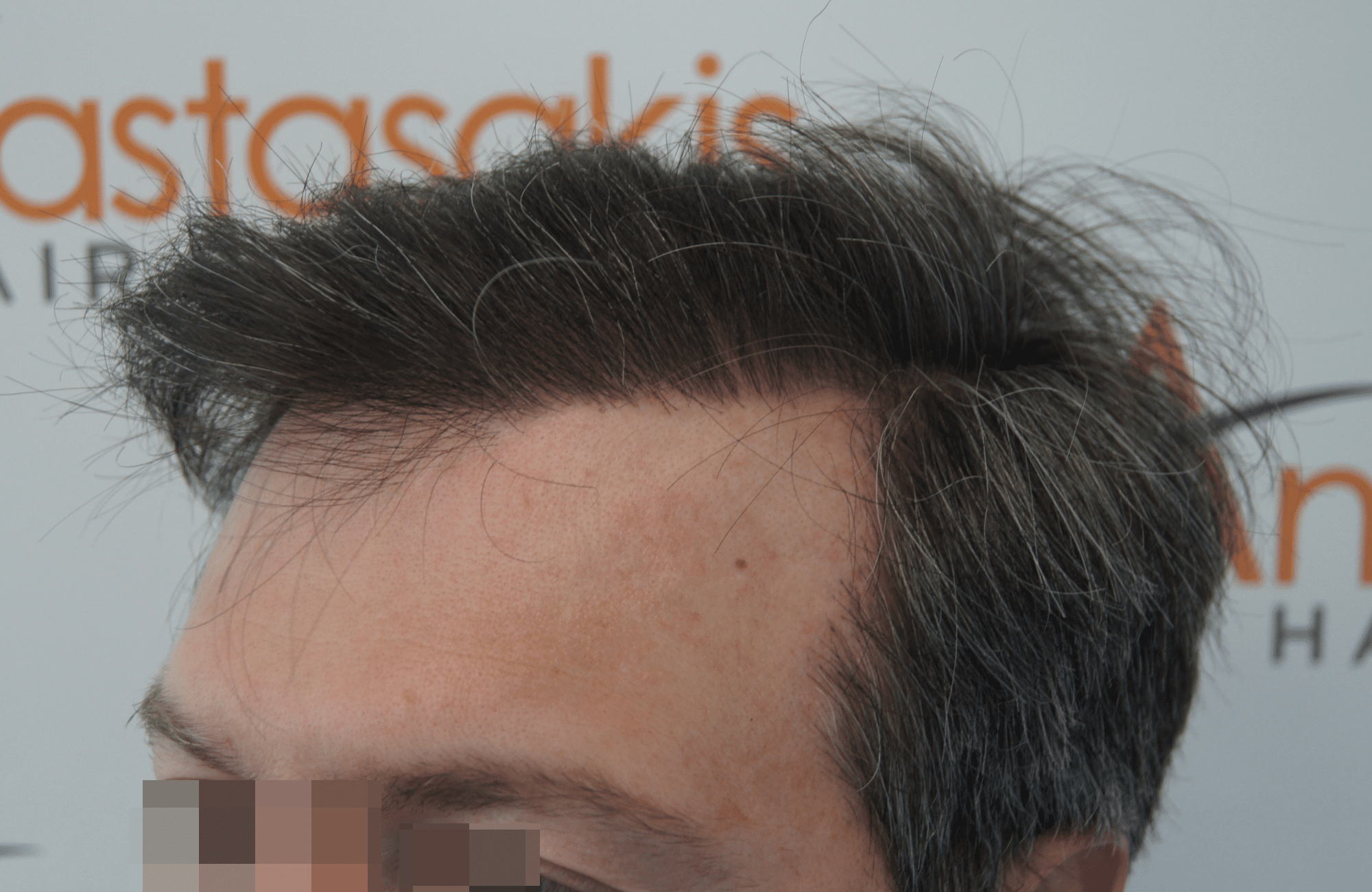 hair transplant result with 2500 follicular units anastasakis hair clinic