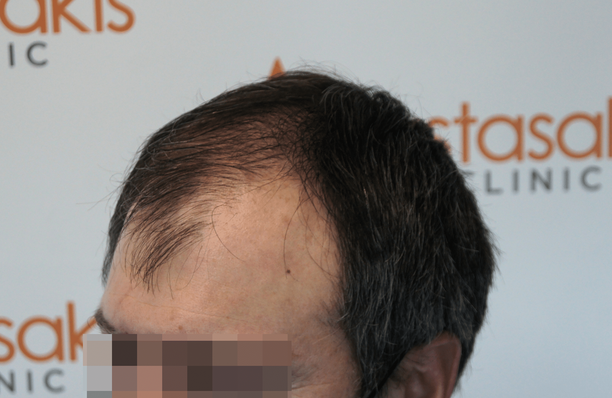 hair transplant result with 2500 follicular units anastasakis hair clinic